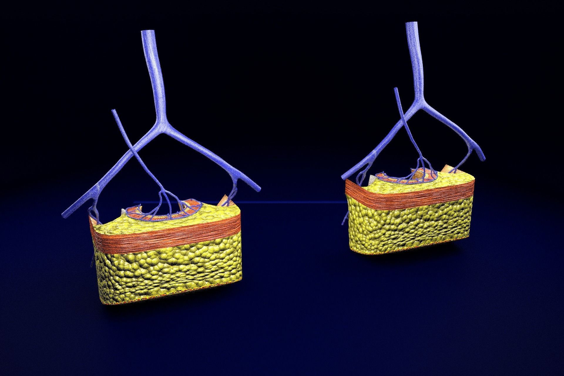 hemorrhoids piles 3D model_71