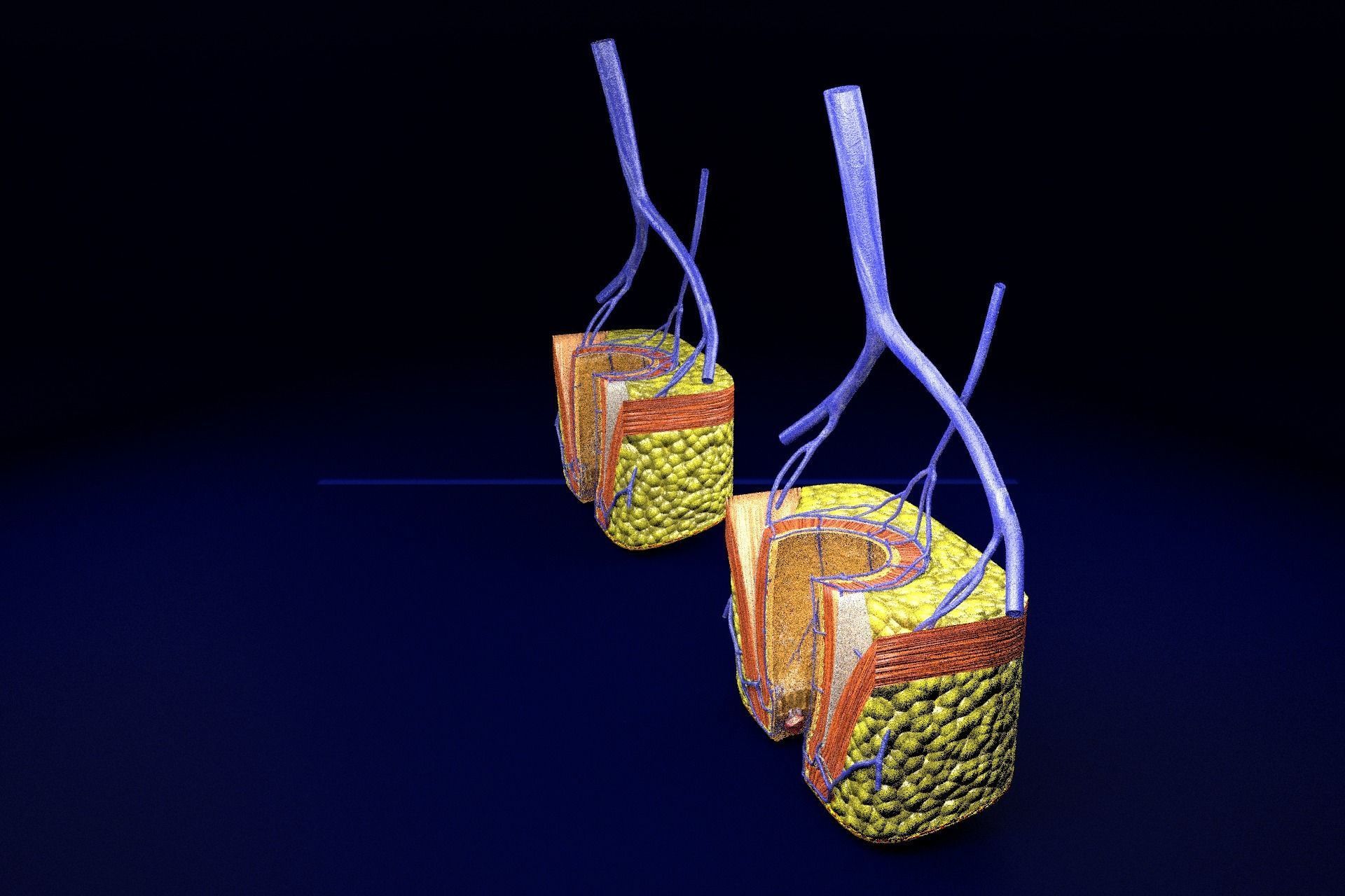 hemorrhoids piles 3D model_25