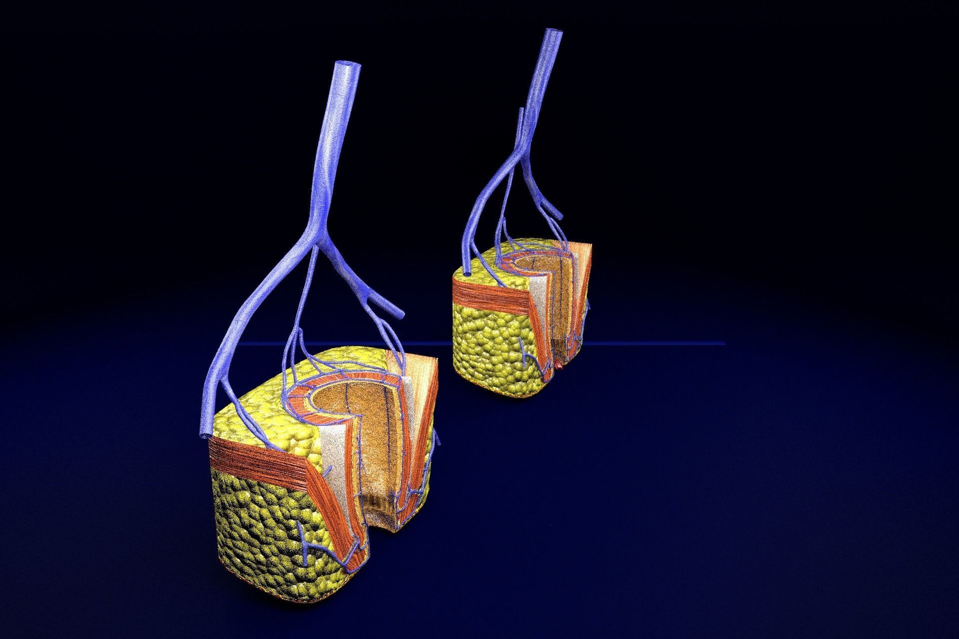 hemorrhoids piles 3D model_59