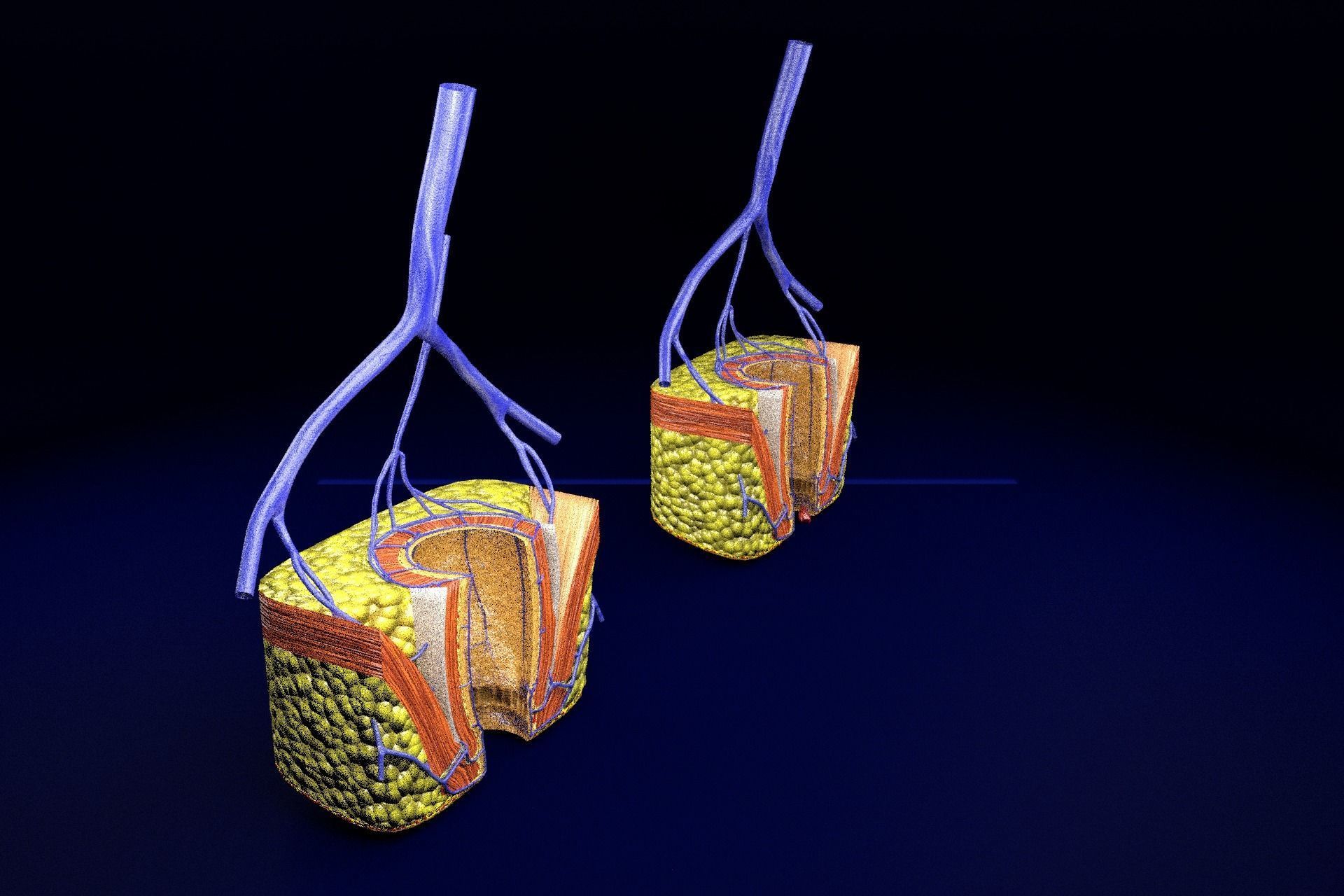 hemorrhoids piles 3D model_81