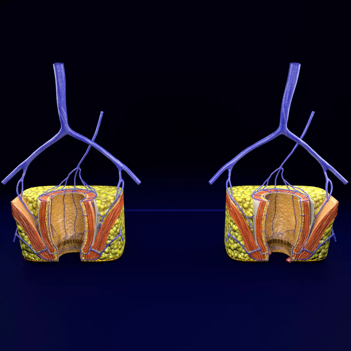 hemorrhoids piles 3D model_0