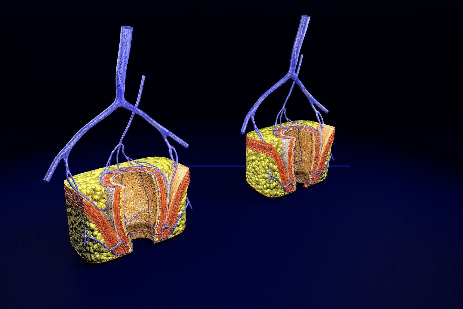 hemorrhoids piles 3D model_36