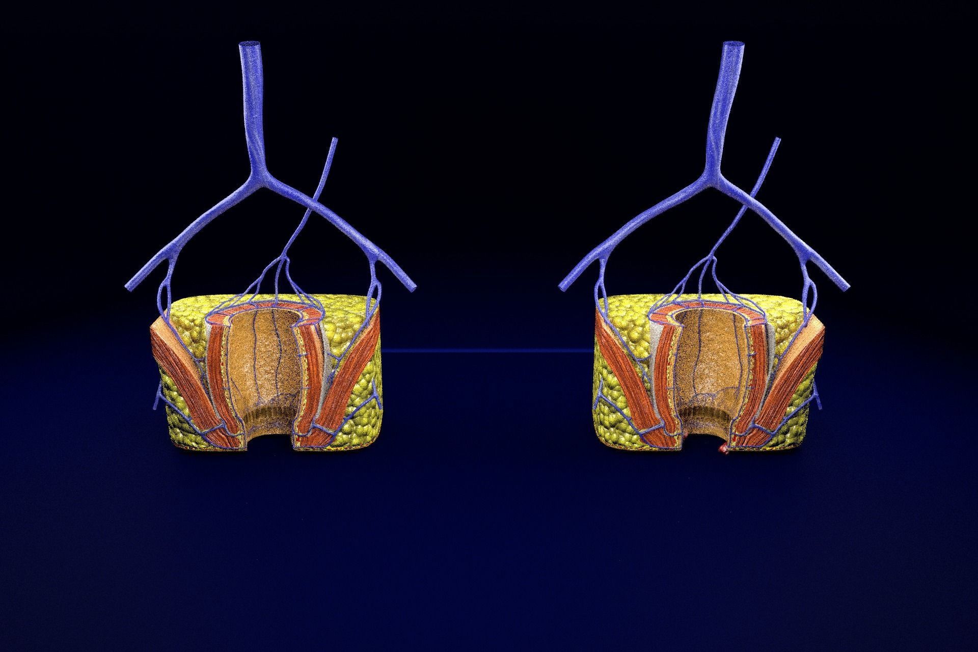 hemorrhoids piles 3D model_30