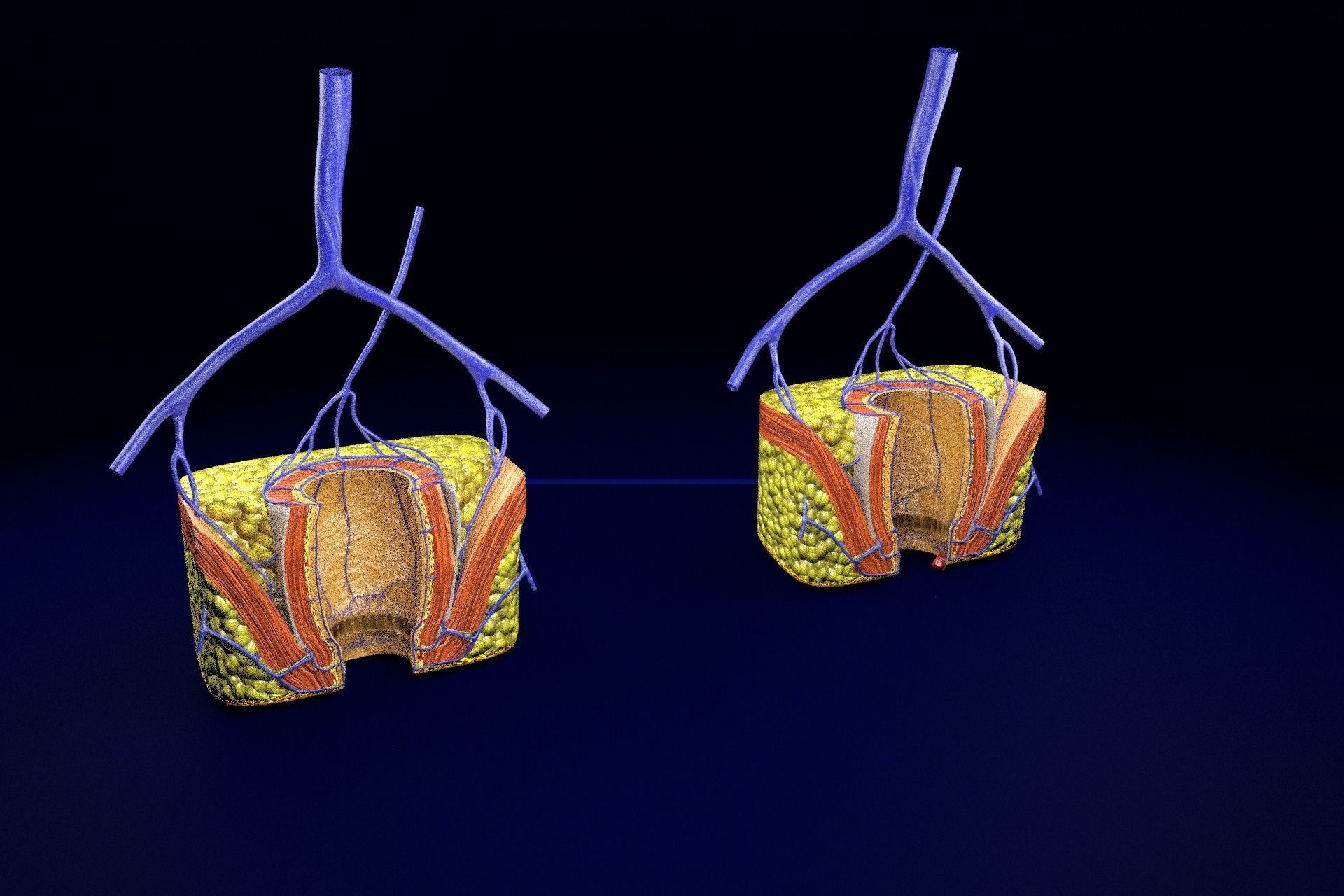 hemorrhoids piles 3D model_38