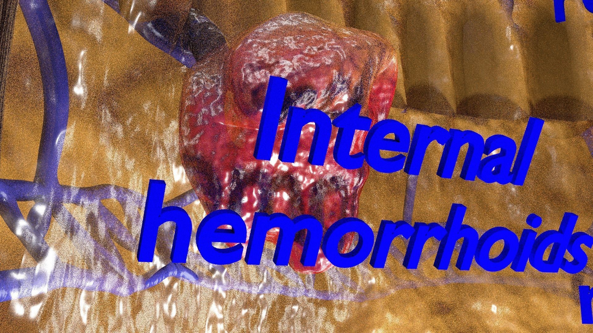 hemorrhoids piles 3D model_18