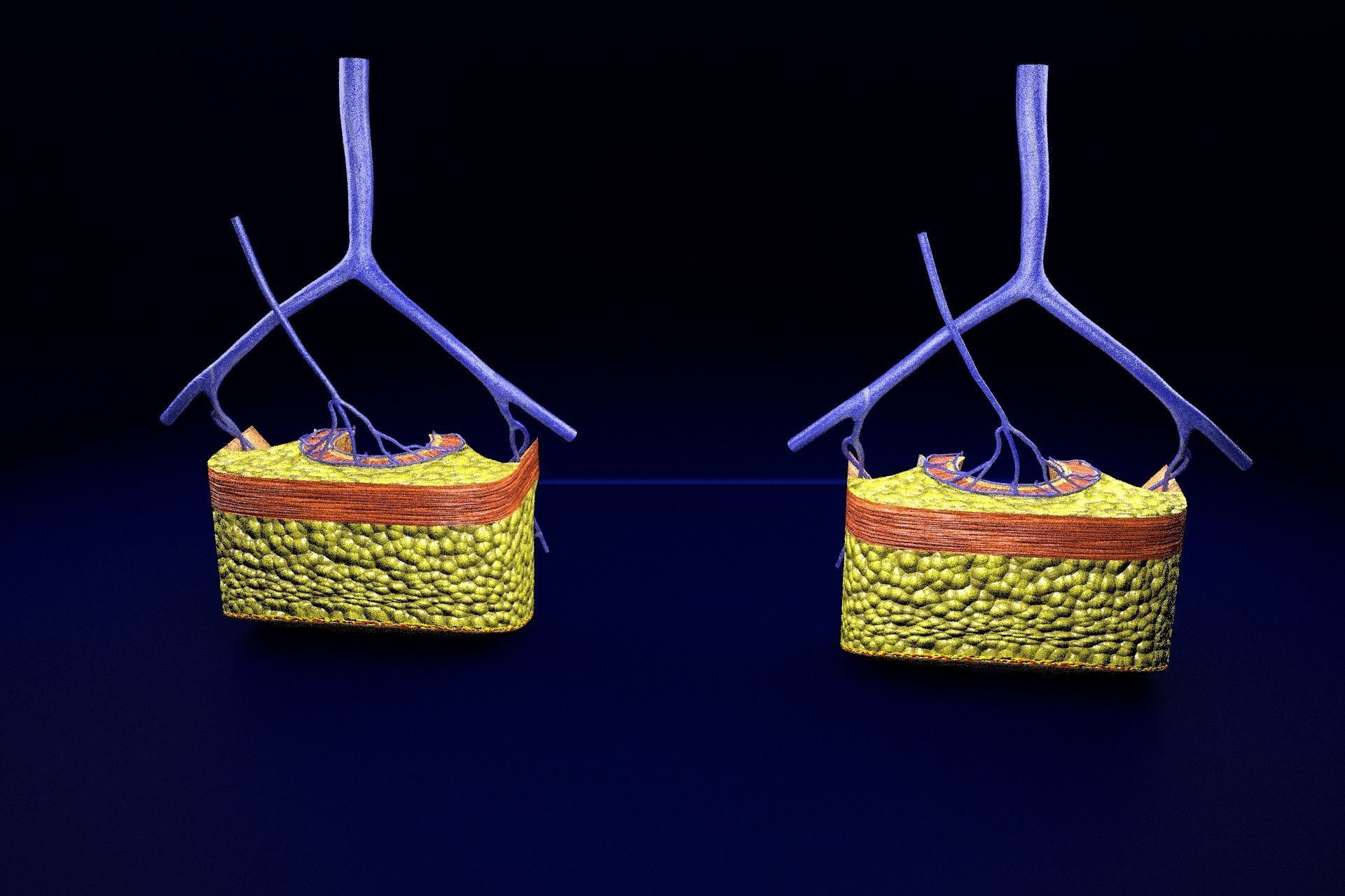 hemorrhoids piles 3D model_58