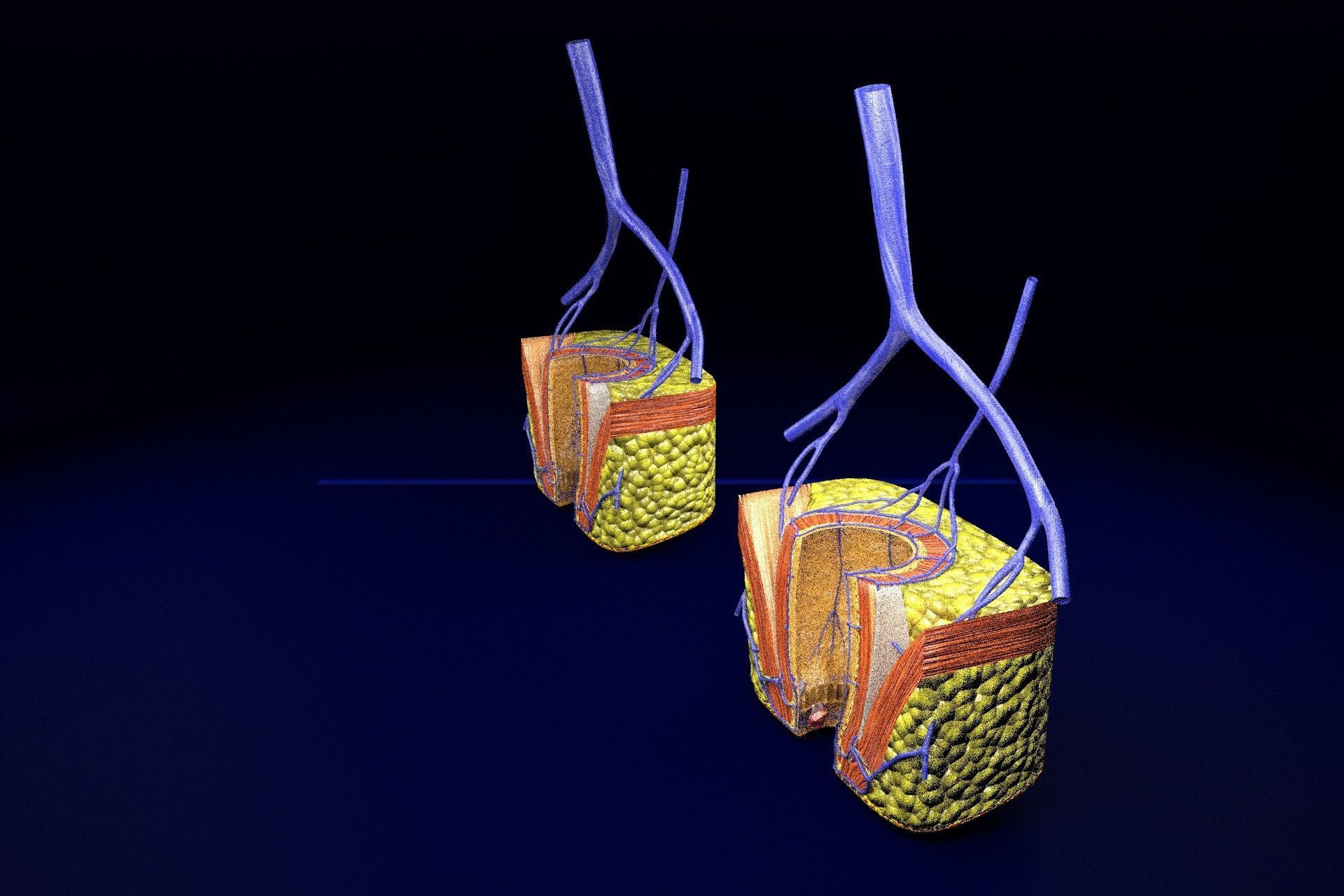 hemorrhoids piles 3D model_76