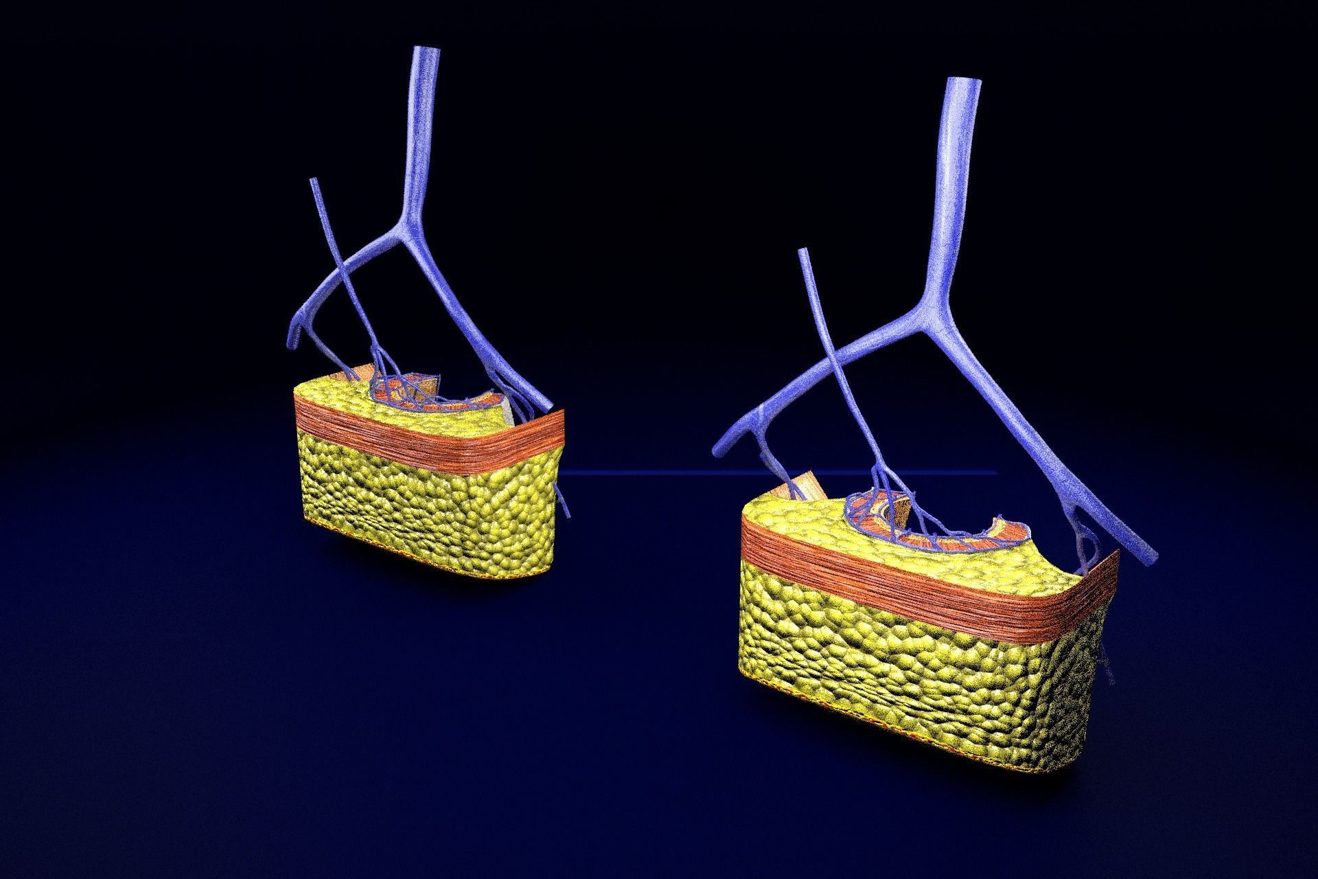 hemorrhoids piles 3D model_68