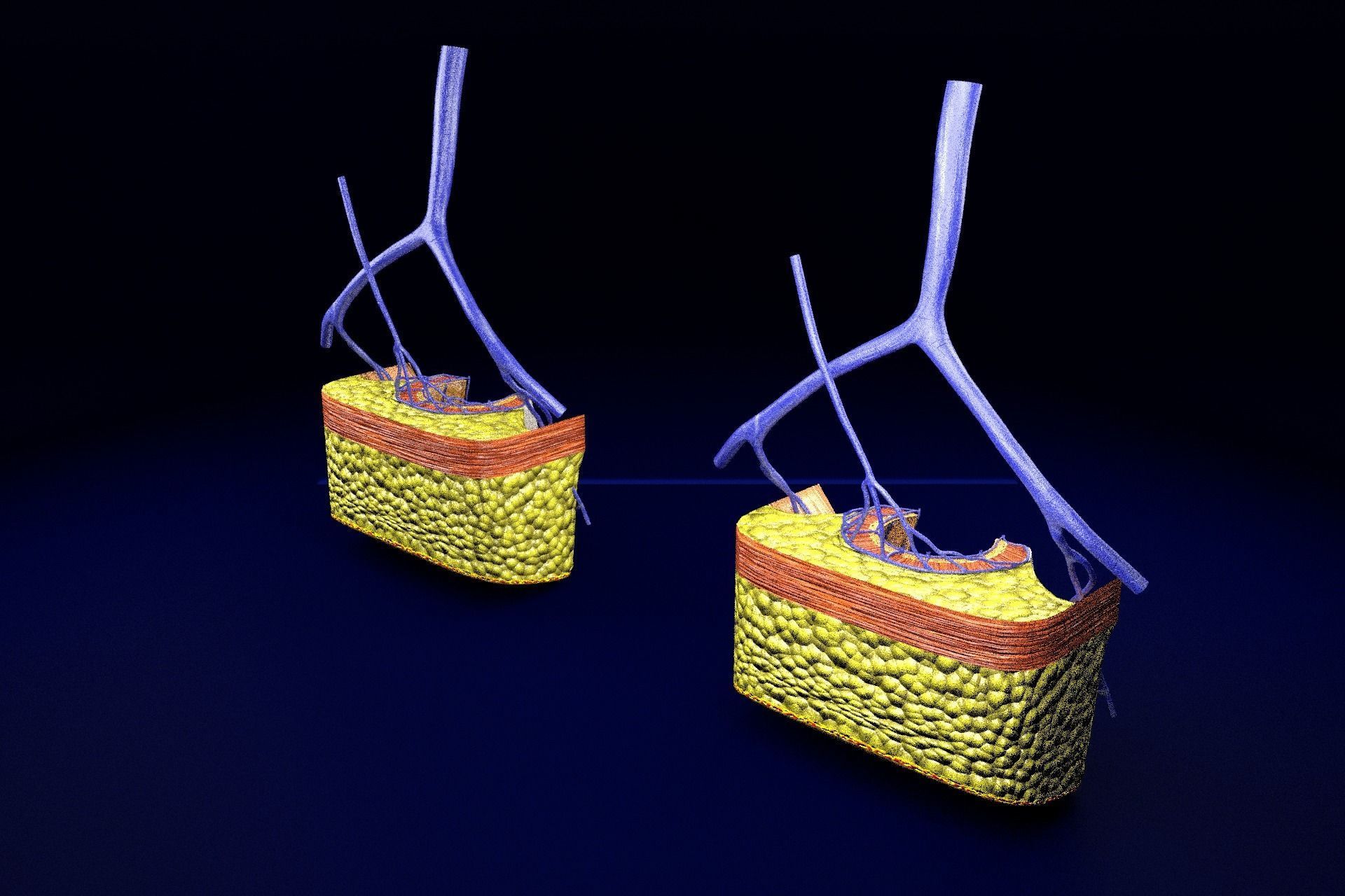 hemorrhoids piles 3D model_78