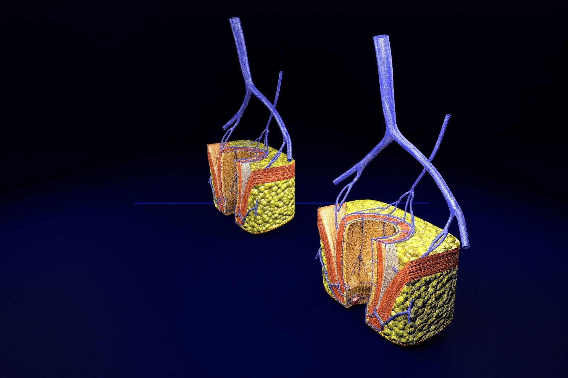 hemorrhoids piles 3D model_32