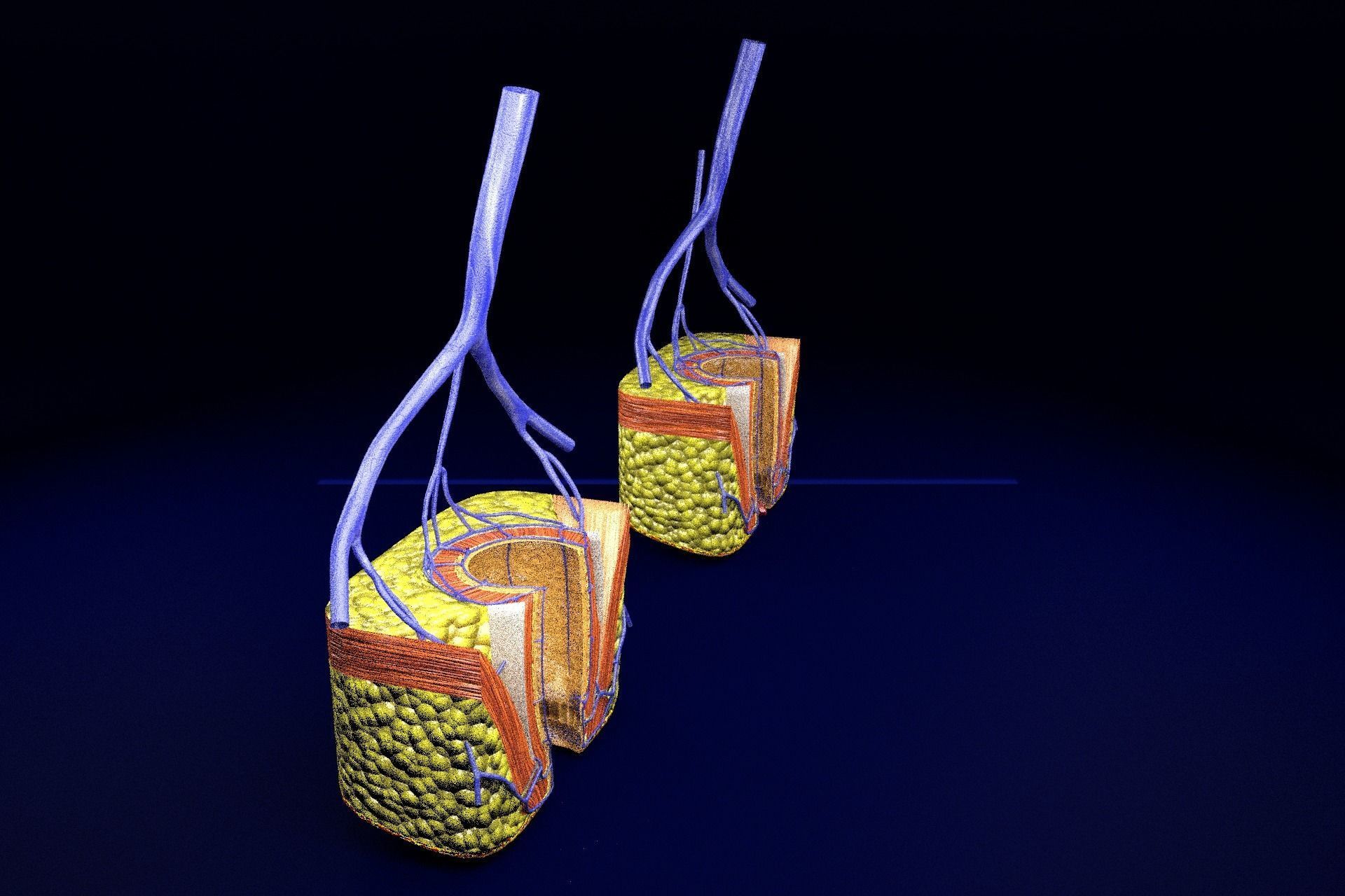 hemorrhoids piles 3D model_60