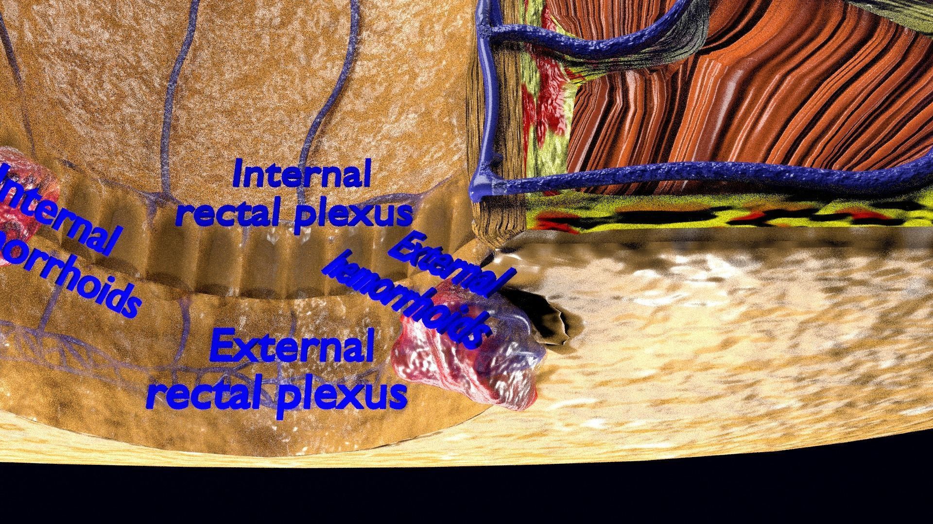 hemorrhoids piles 3D model_20