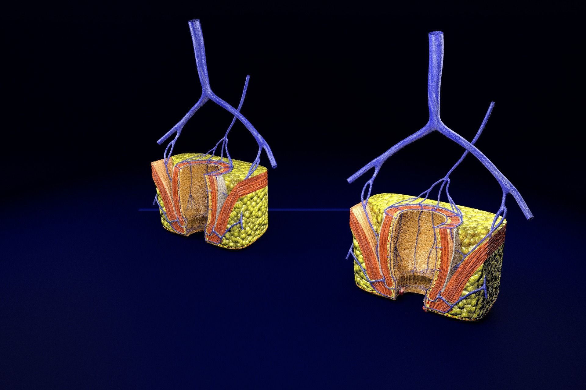 hemorrhoids piles 3D model_69