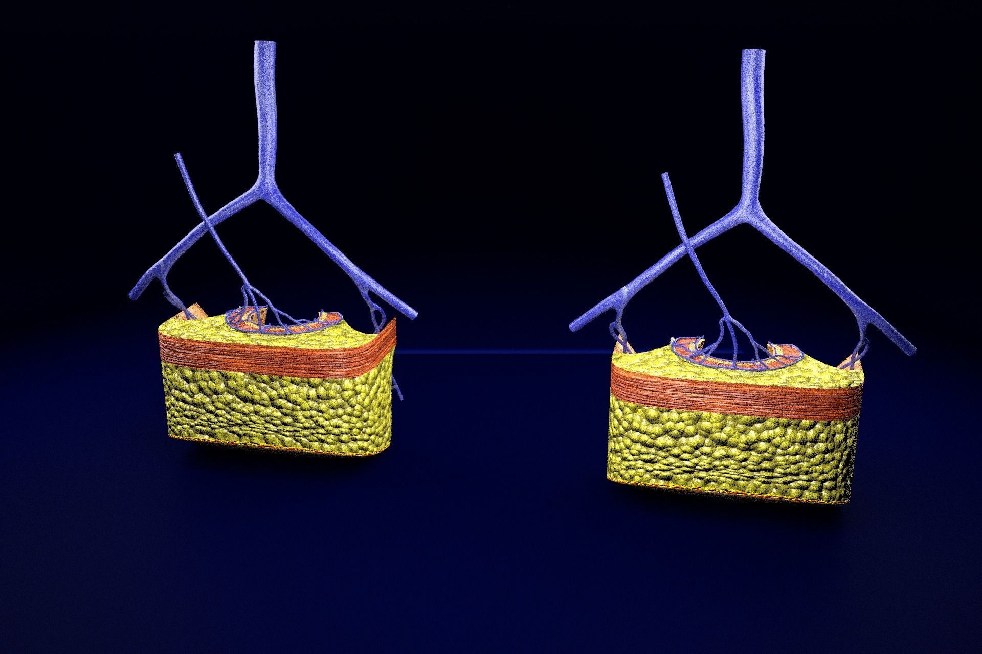 hemorrhoids piles 3D model_22
