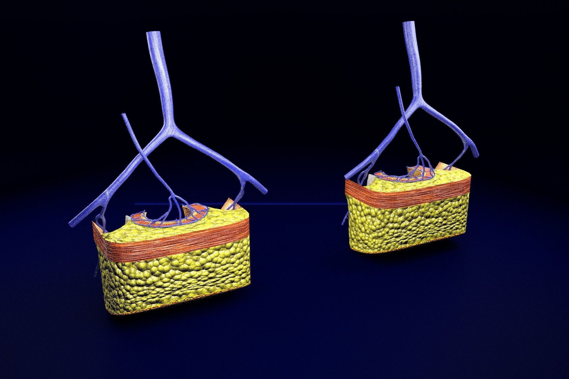 hemorrhoids piles 3D model_43