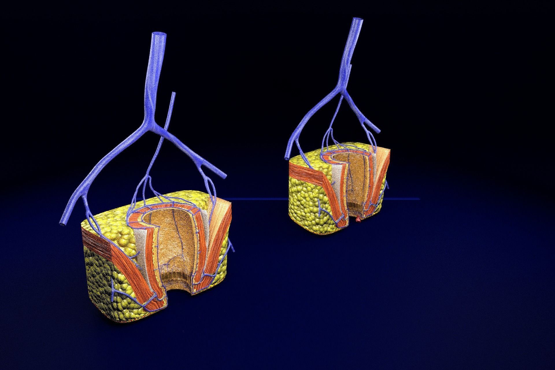 hemorrhoids piles 3D model_85
