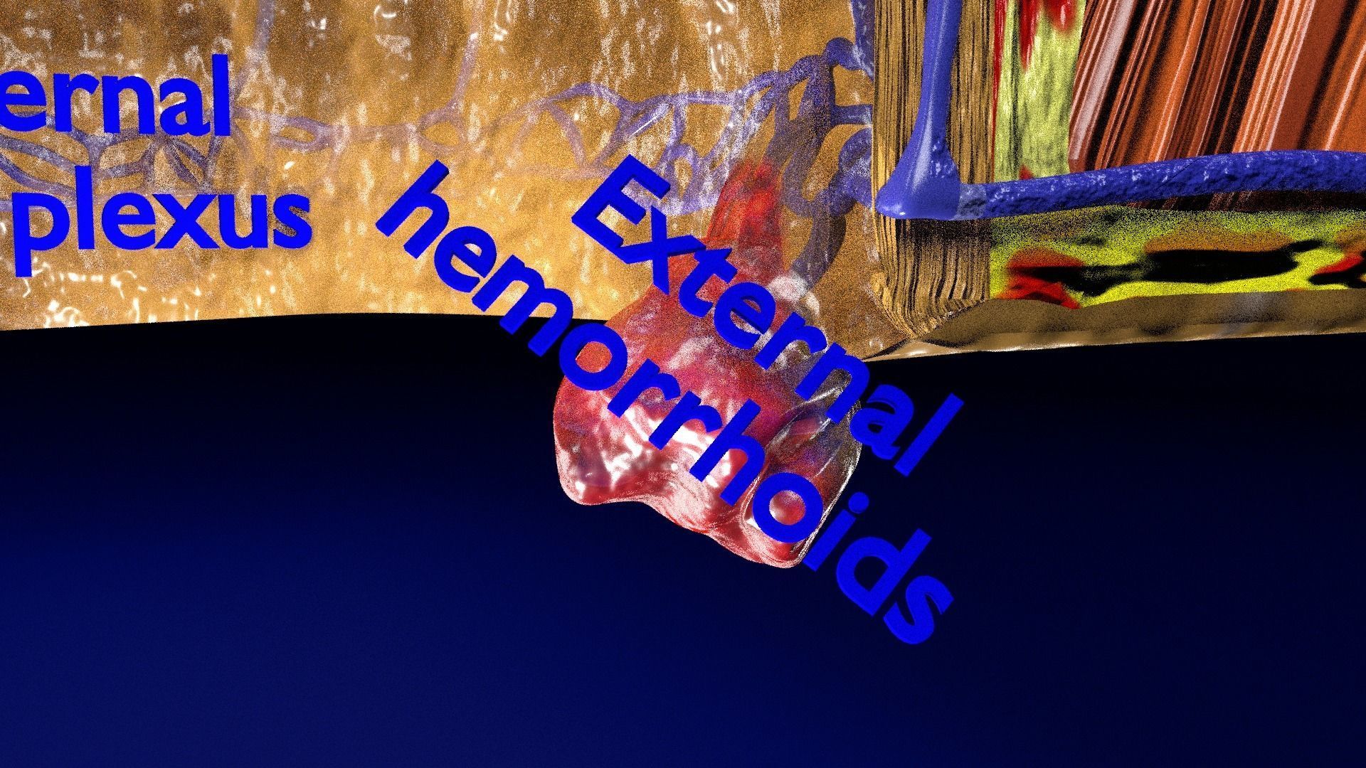 hemorrhoids piles 3D model_13