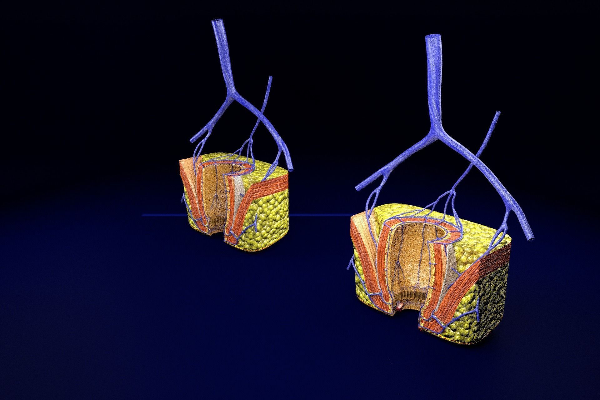 hemorrhoids piles 3D model_86