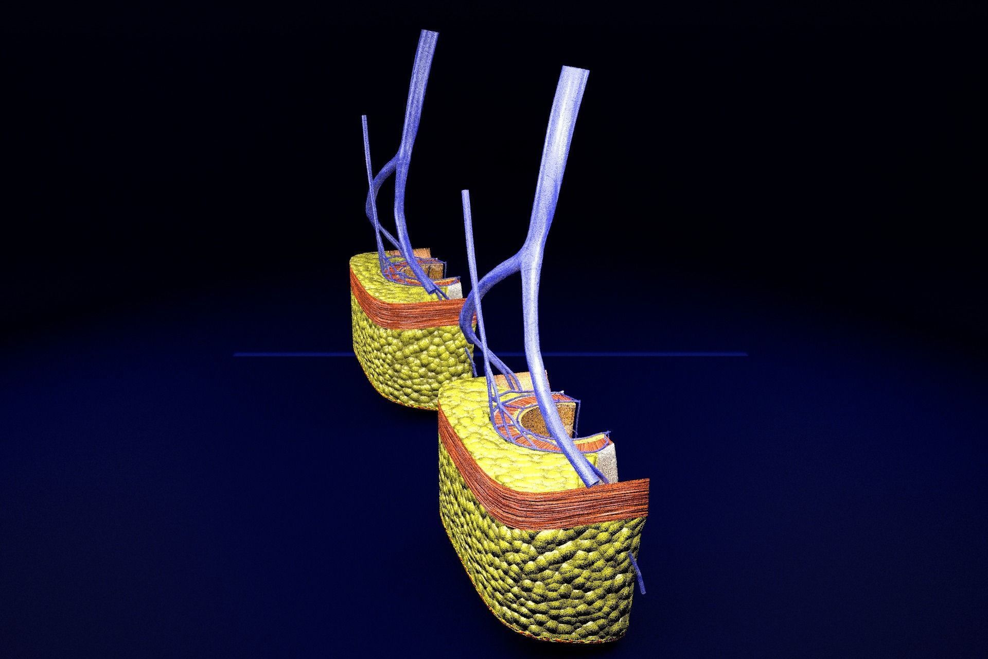 hemorrhoids piles 3D model_53