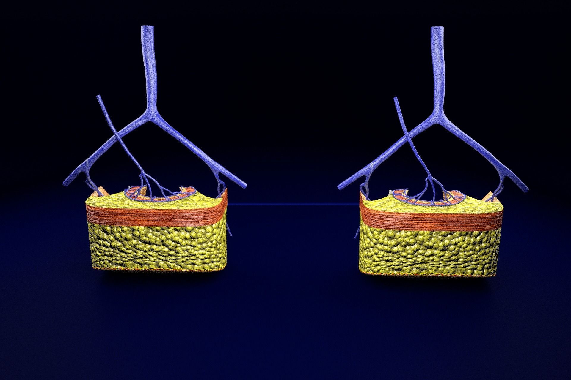 hemorrhoids piles 3D model_21