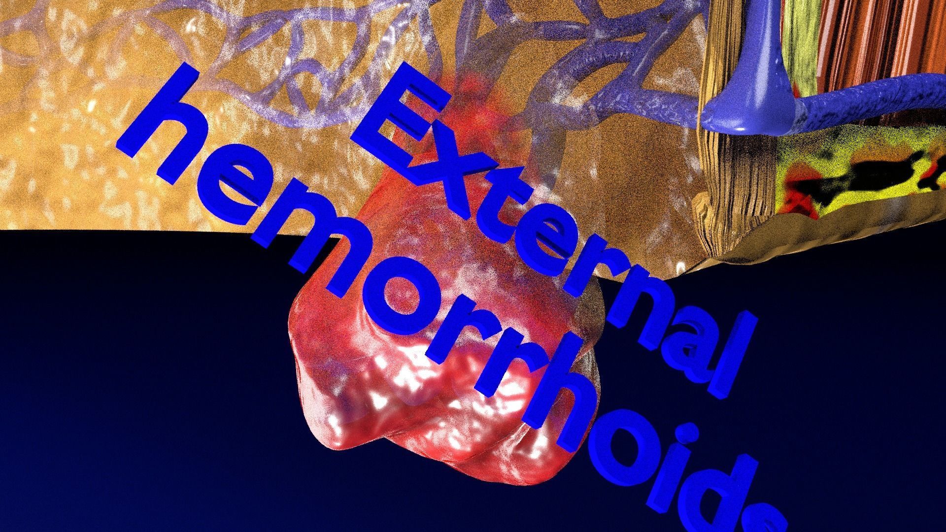 hemorrhoids piles 3D model_15