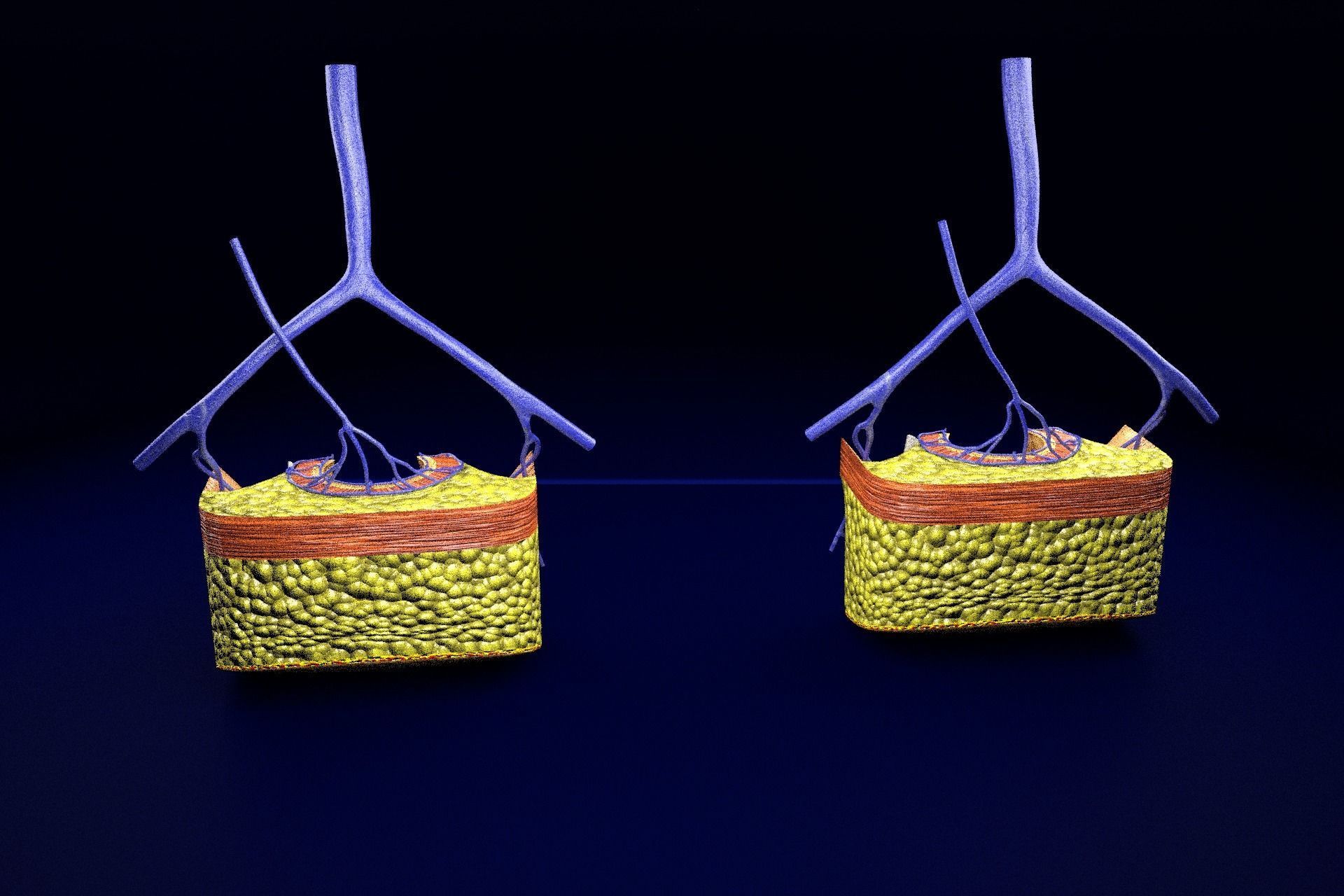 hemorrhoids piles 3D model_62