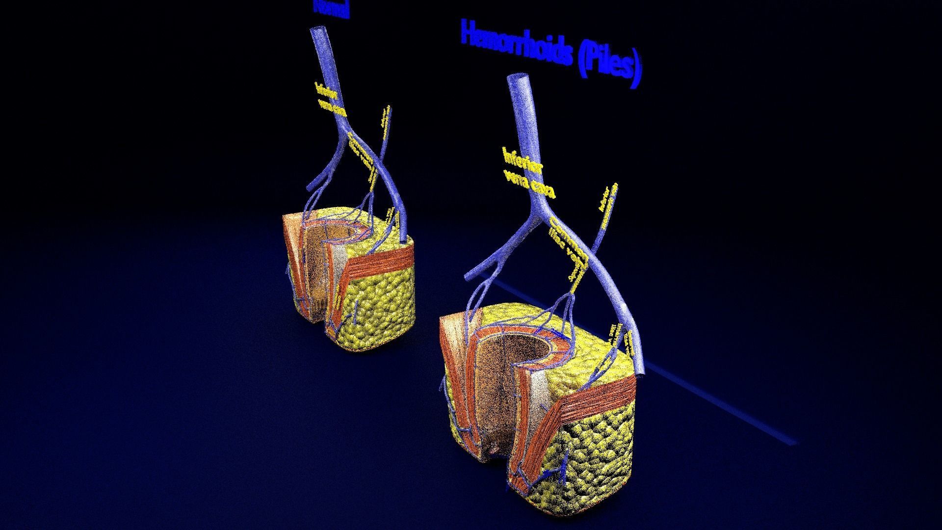 hemorrhoids piles 3D model_3