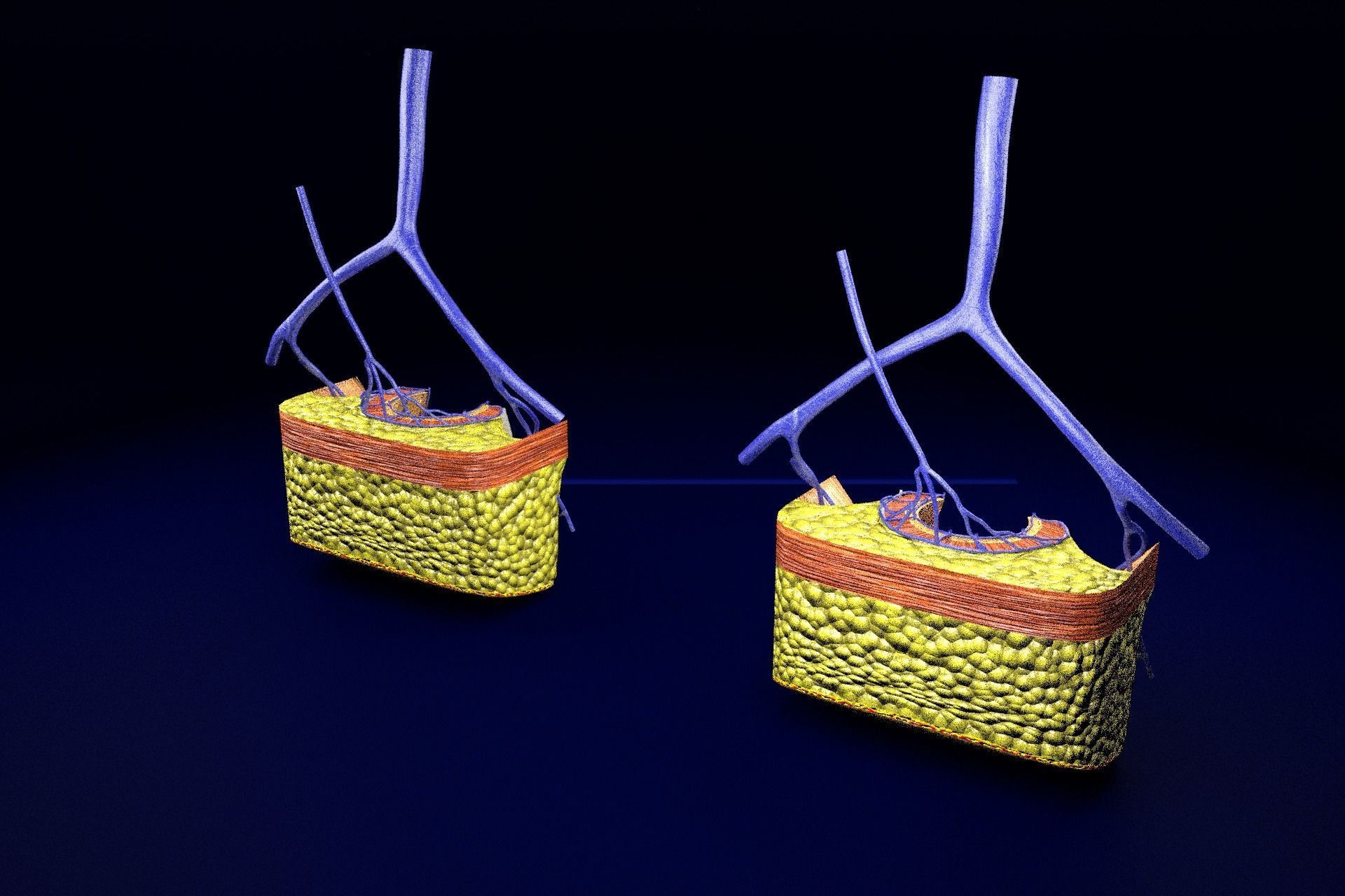 hemorrhoids piles 3D model_51