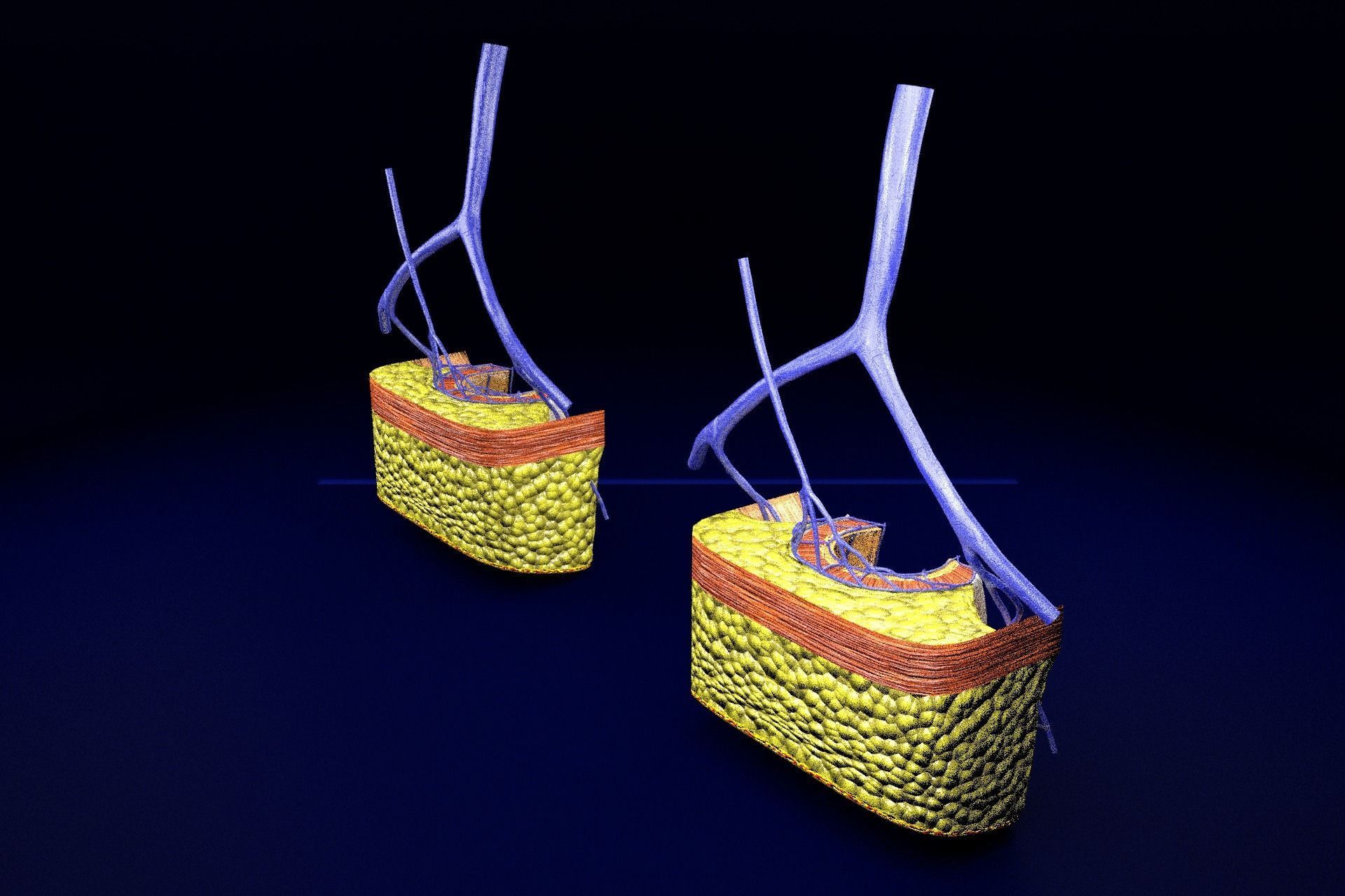 hemorrhoids piles 3D model_33
