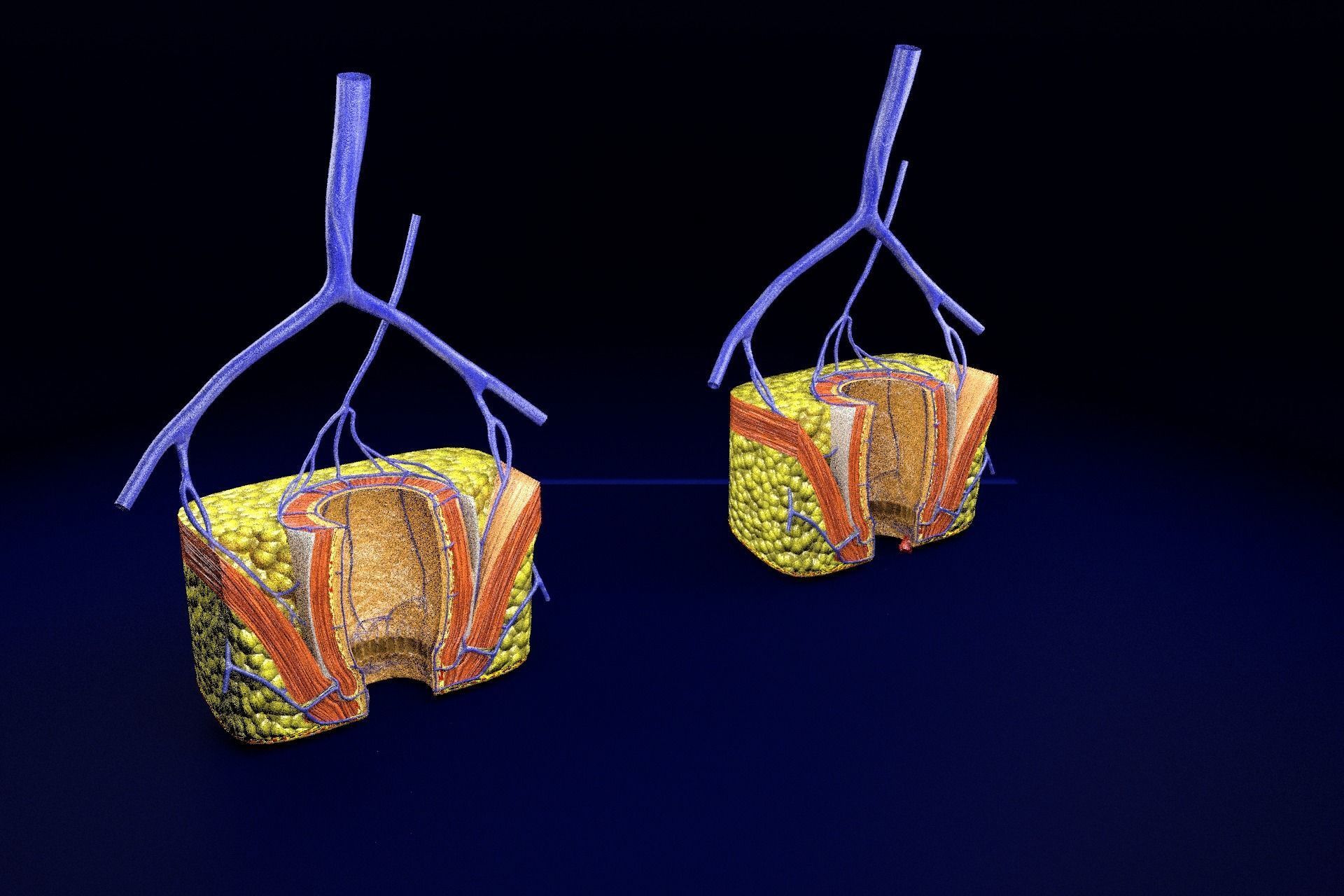 hemorrhoids piles 3D model_40