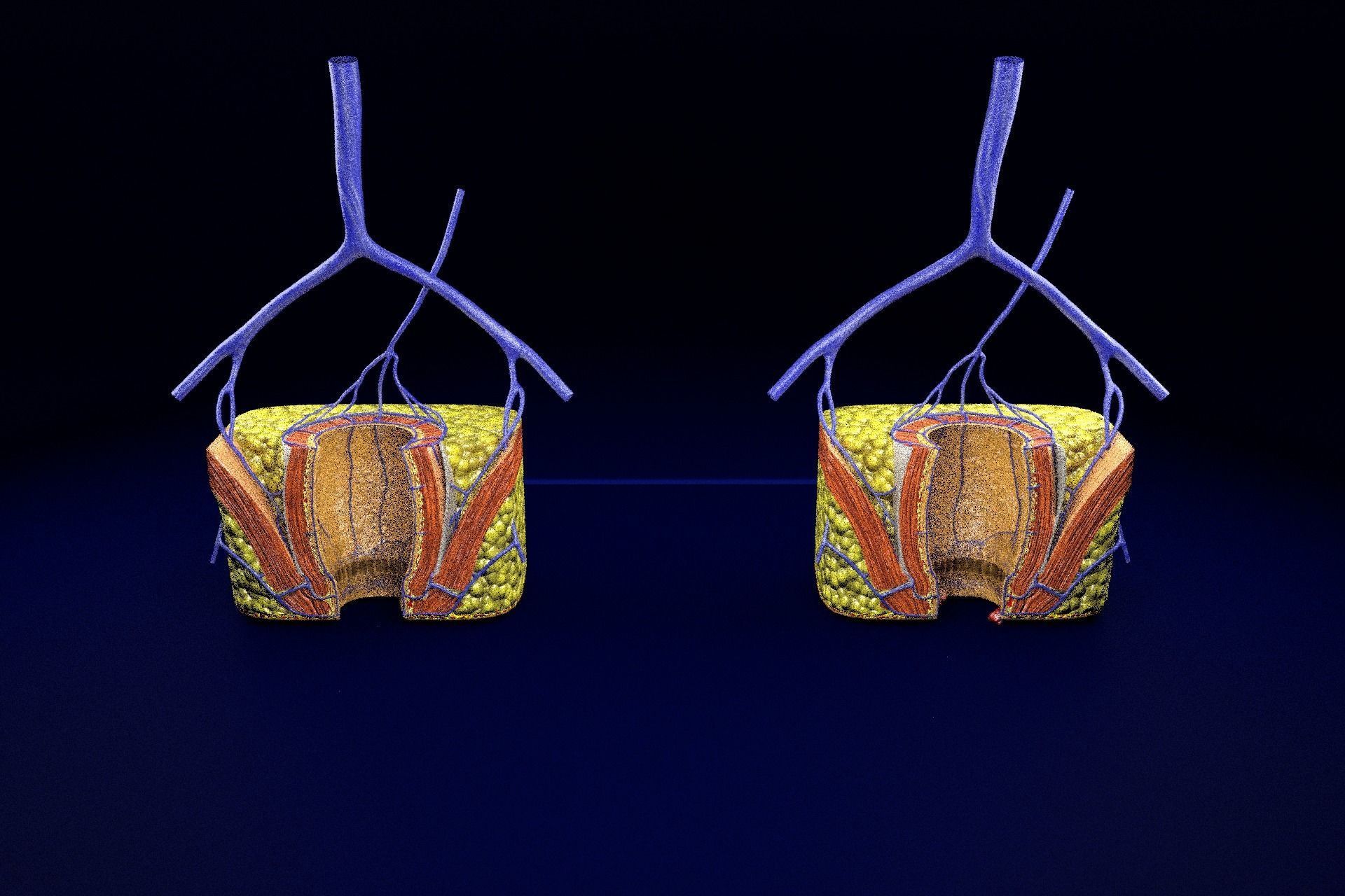 hemorrhoids piles 3D model_24