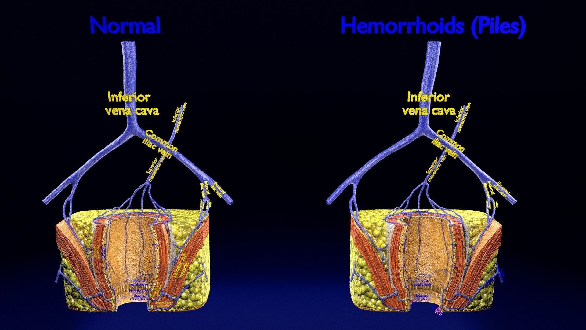 hemorrhoids piles 3D model_10