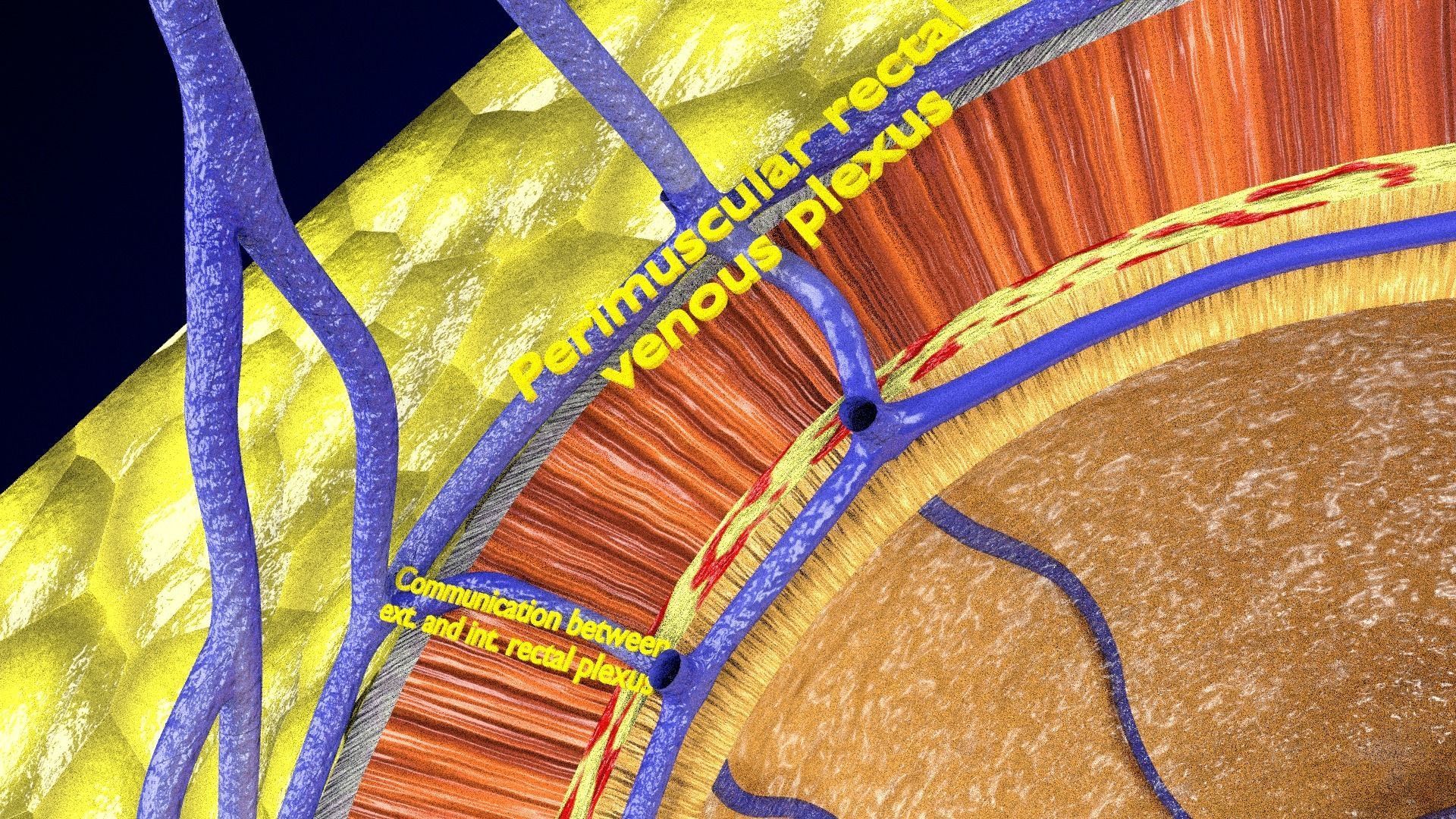 hemorrhoids piles 3D model_16
