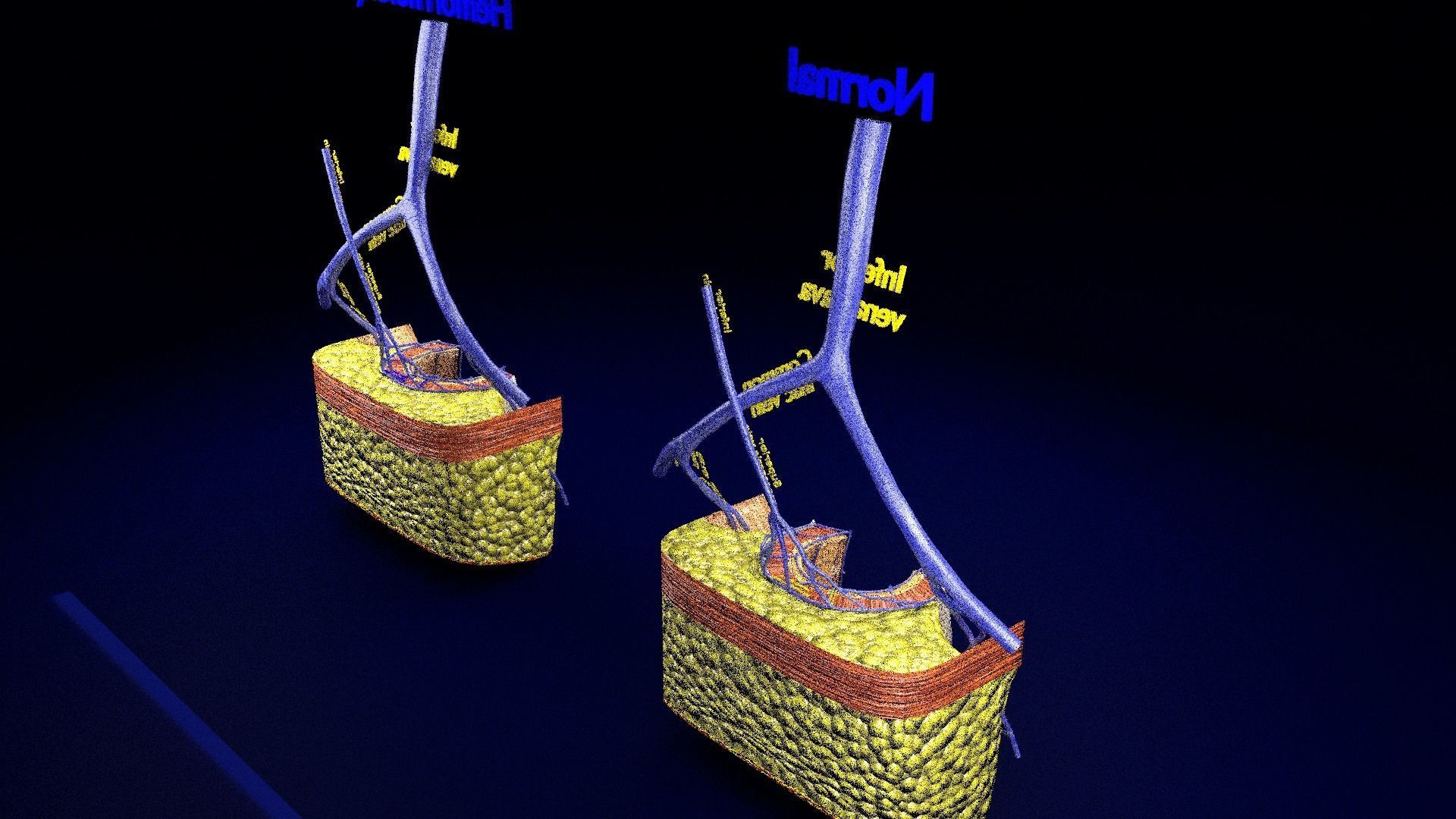 hemorrhoids piles 3D model_6