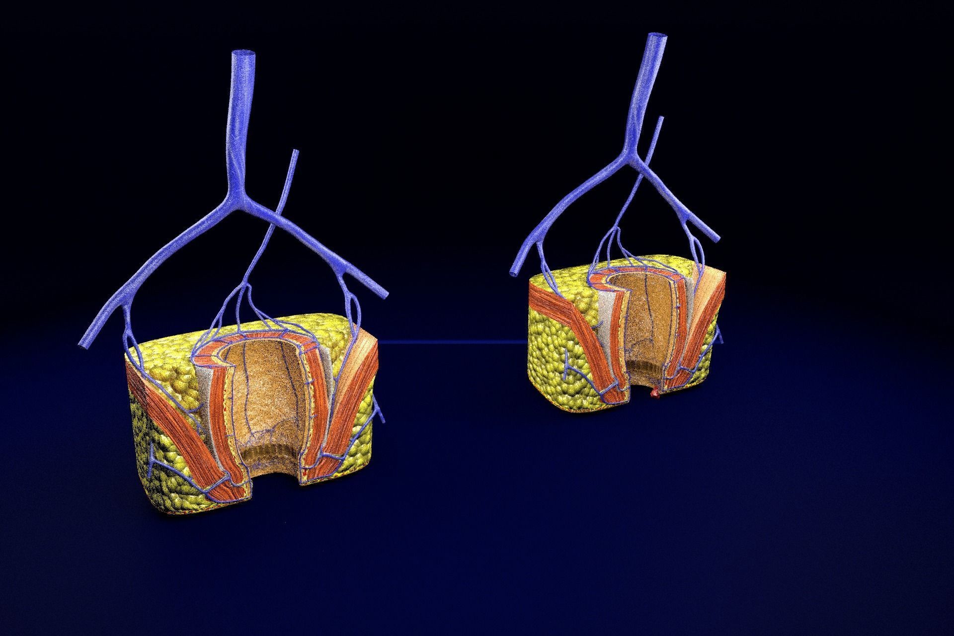 hemorrhoids piles 3D model_29