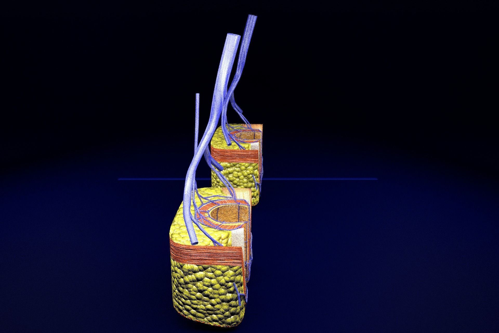 hemorrhoids piles 3D model_27