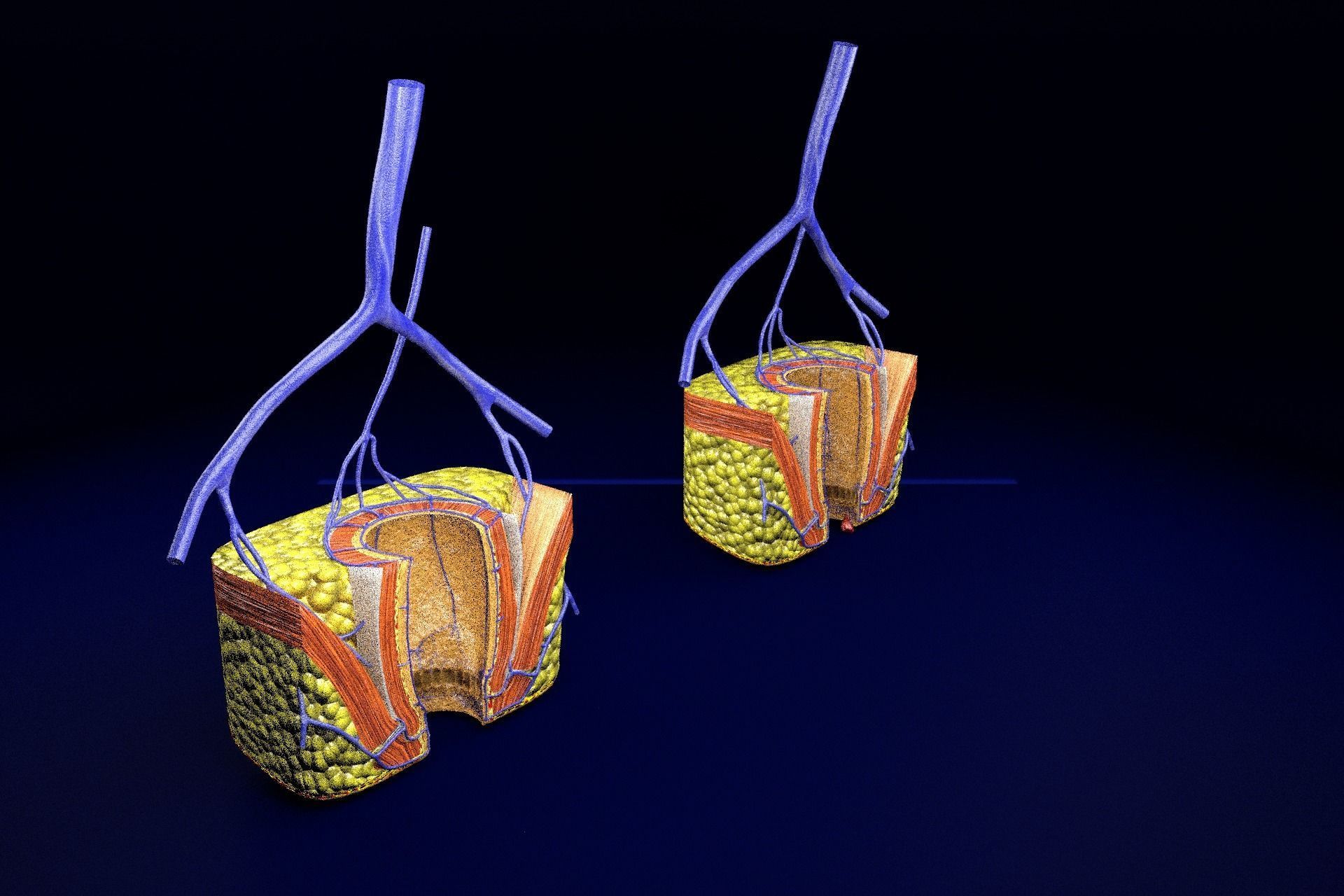 hemorrhoids piles 3D model_80