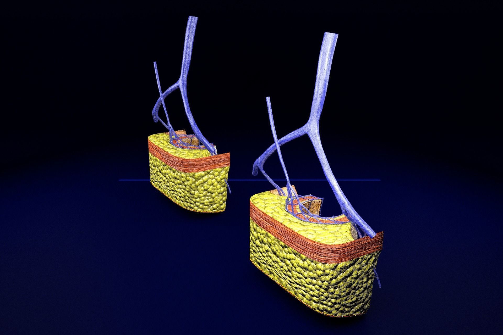 hemorrhoids piles 3D model_31