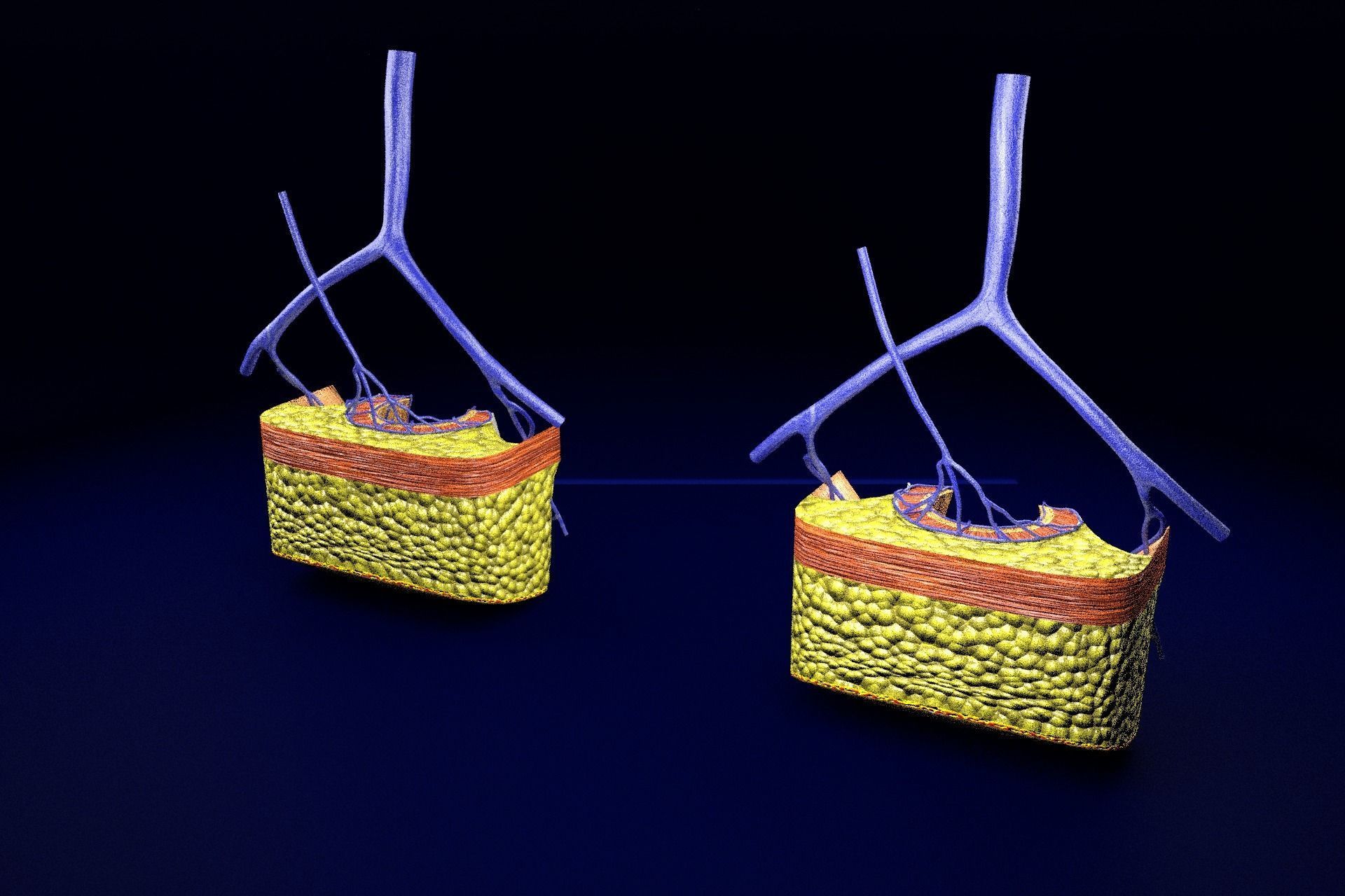 hemorrhoids piles 3D model_34