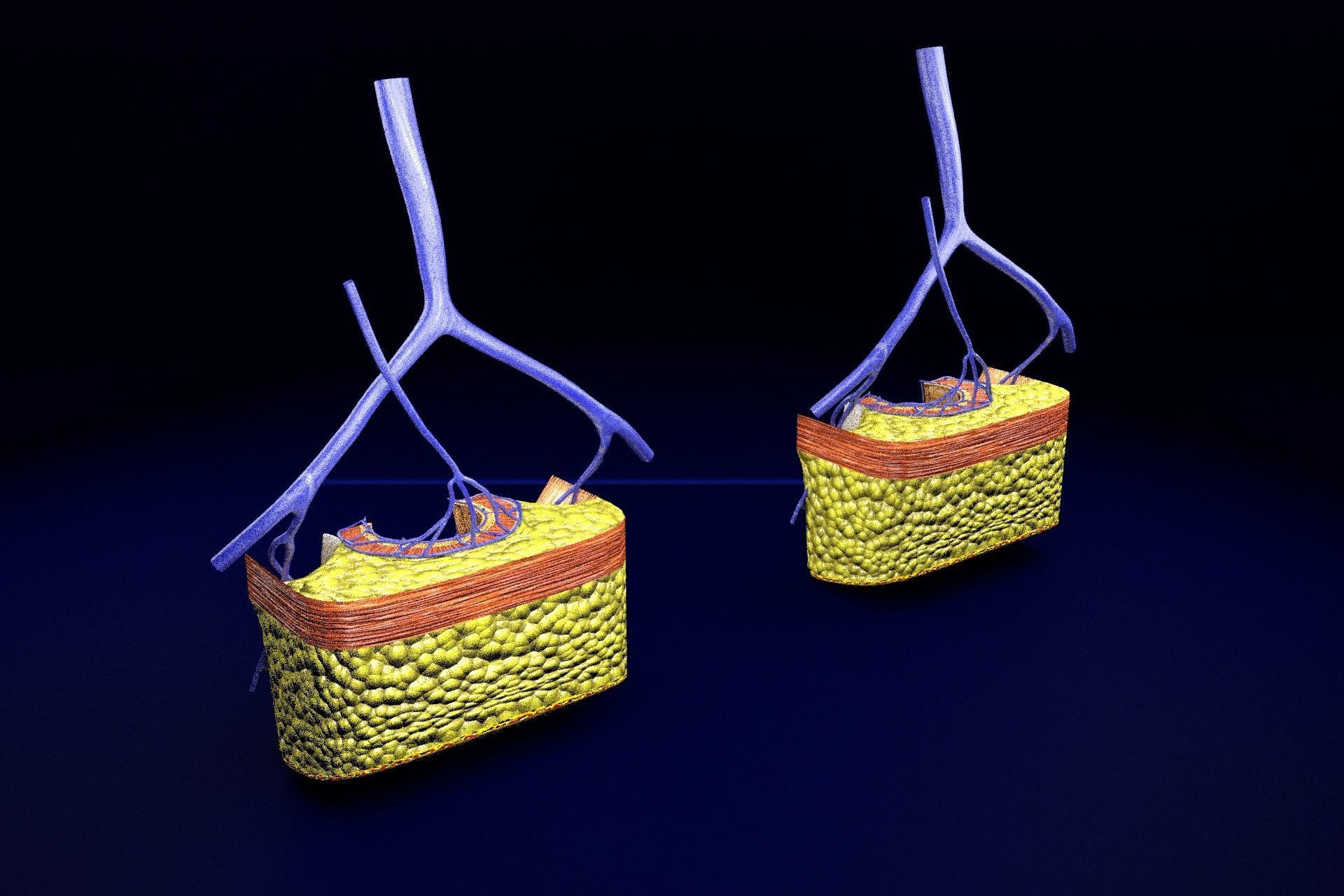 hemorrhoids piles 3D model_73