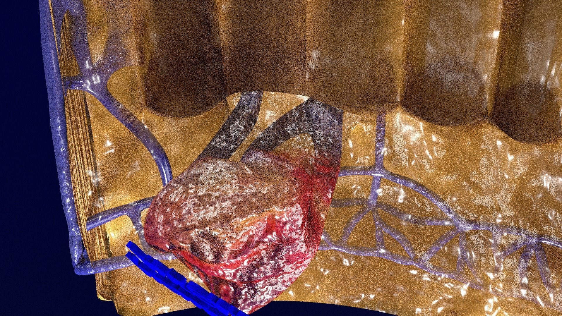 hemorrhoids piles 3D model_19