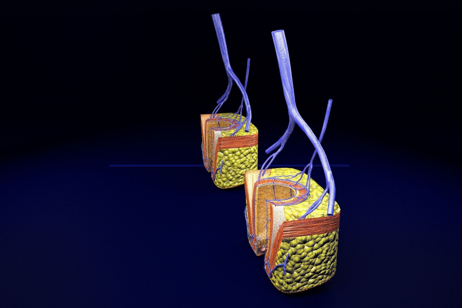 hemorrhoids piles 3D model_42