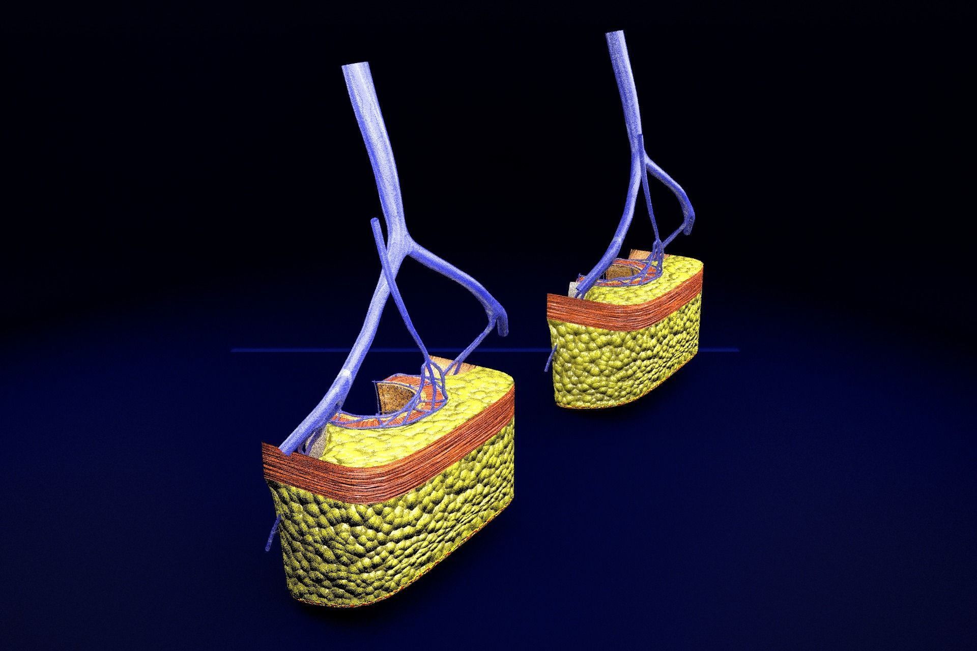 hemorrhoids piles 3D model_75