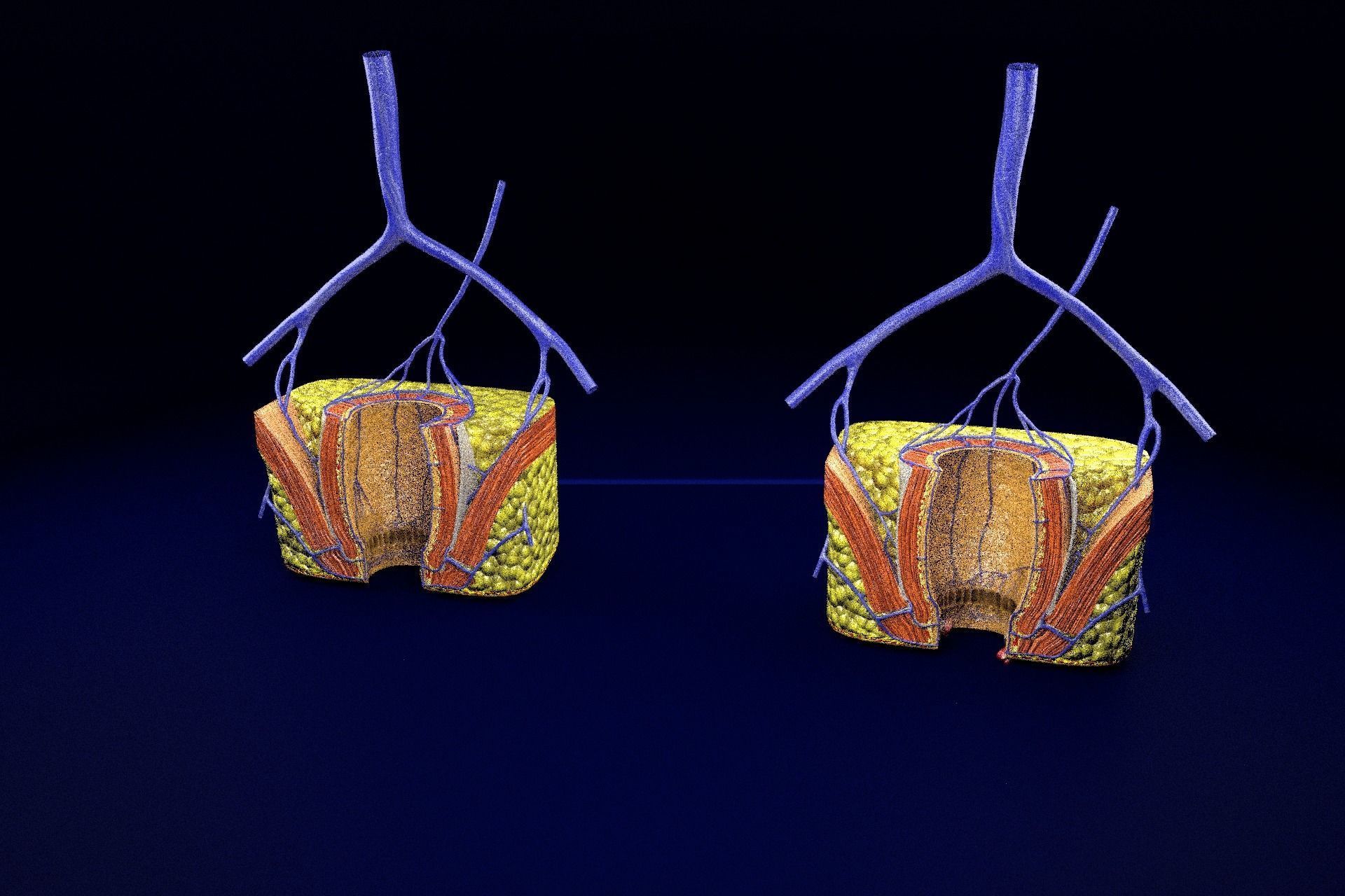 hemorrhoids piles 3D model_88