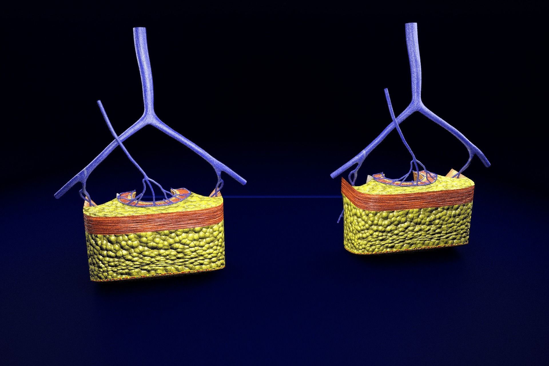 hemorrhoids piles 3D model_66