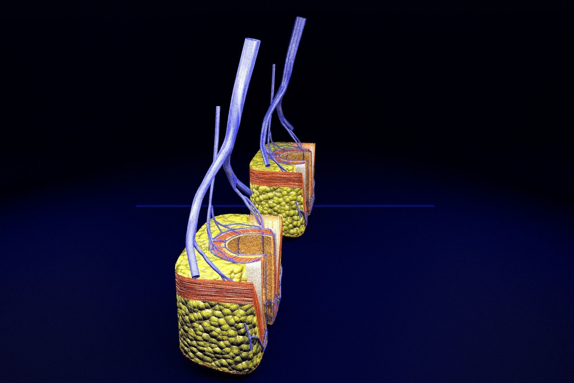 hemorrhoids piles 3D model_45