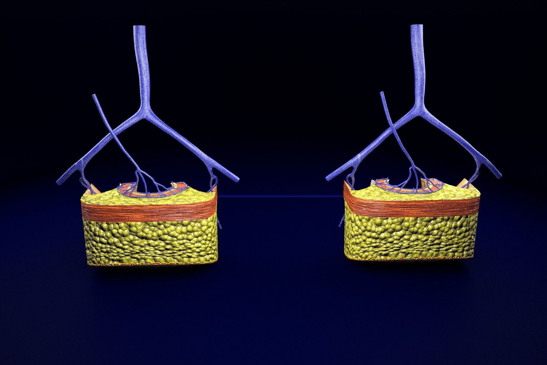 hemorrhoids piles 3D model_63