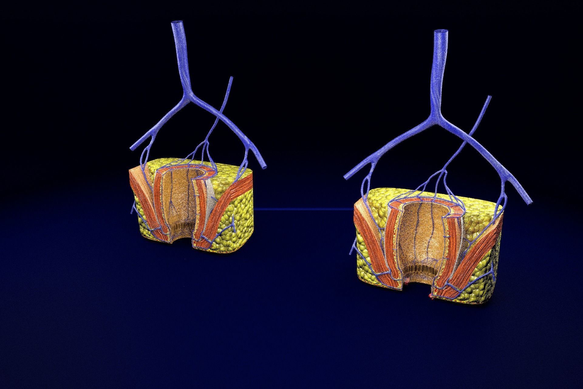 hemorrhoids piles 3D model_84