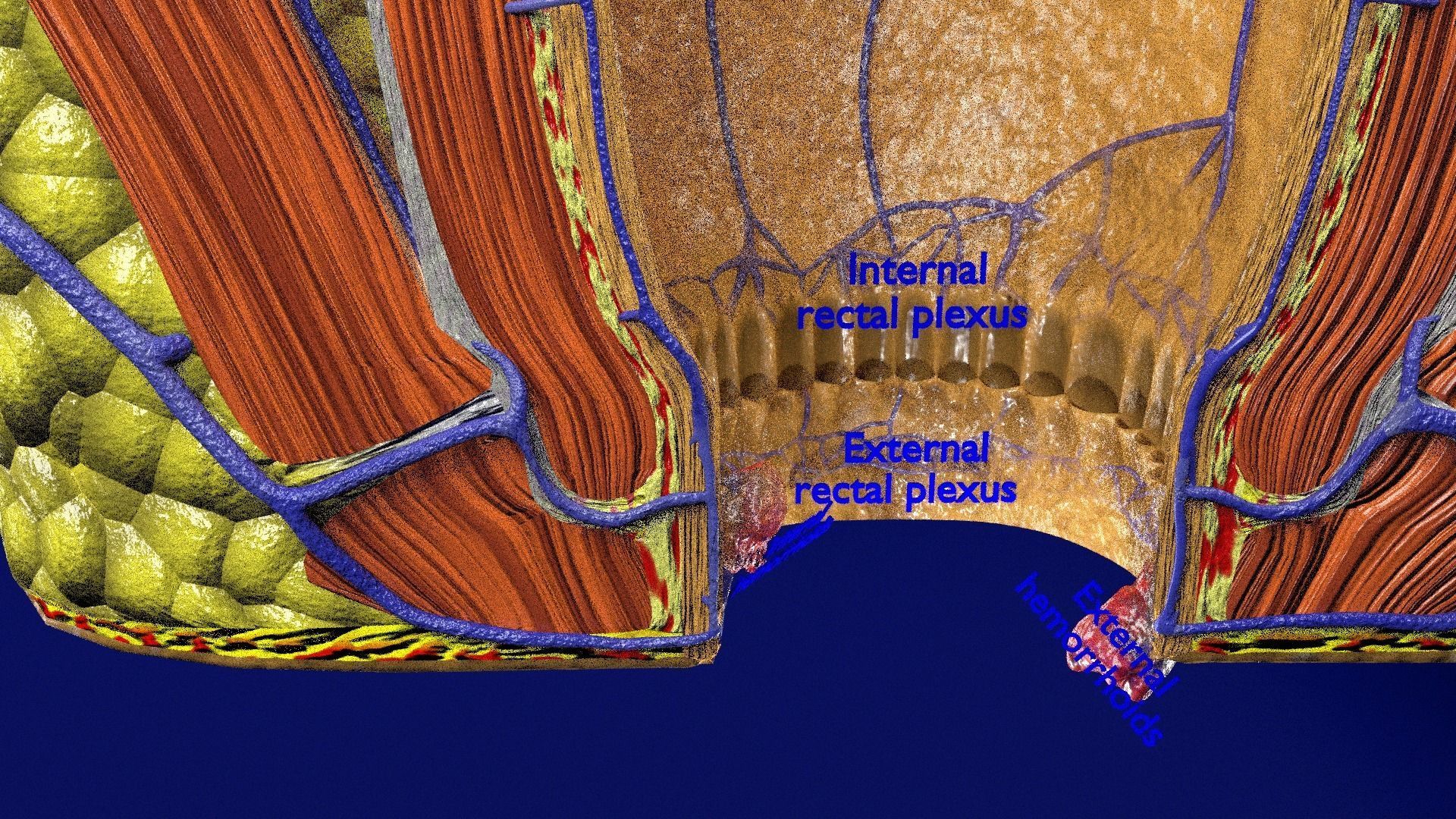 hemorrhoids piles 3D model_17