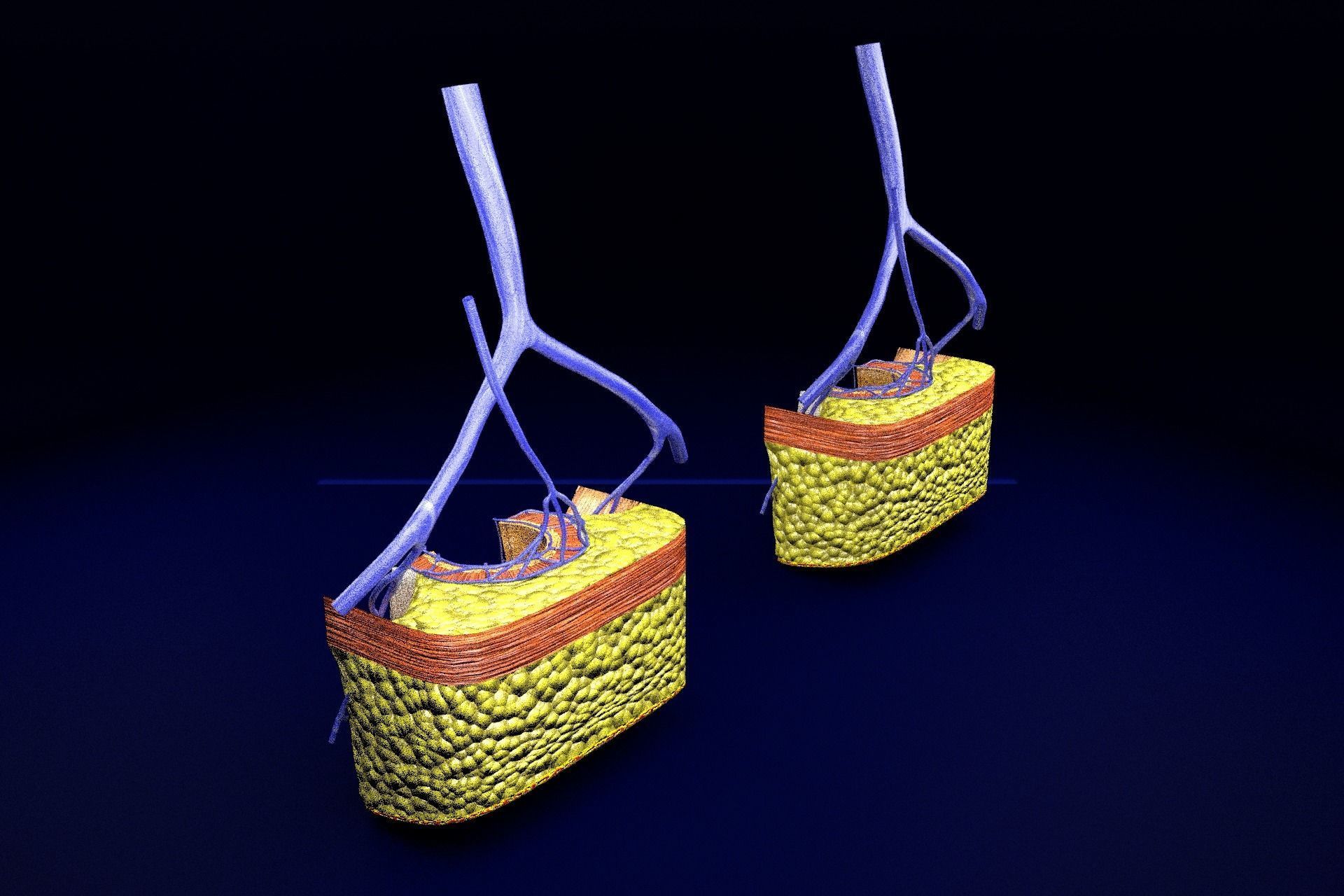 hemorrhoids piles 3D model_82